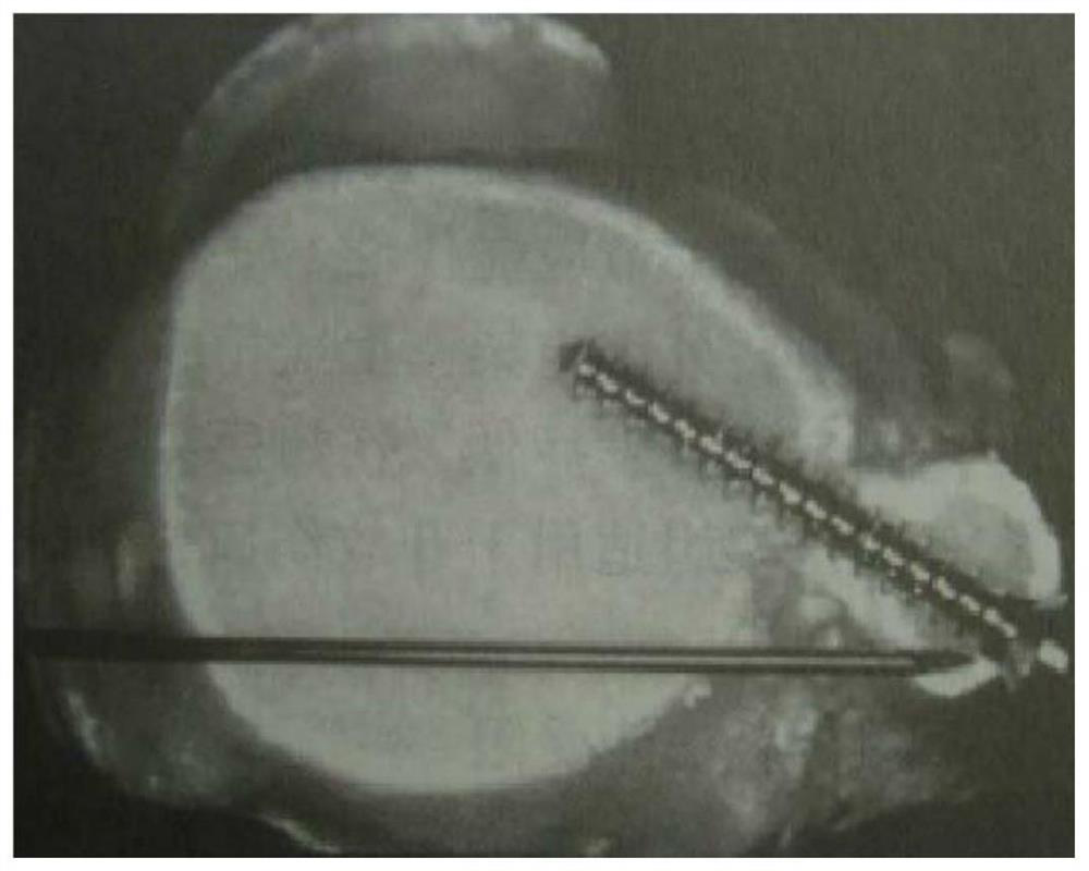 Distal tibiofibular joint screw guide forceps