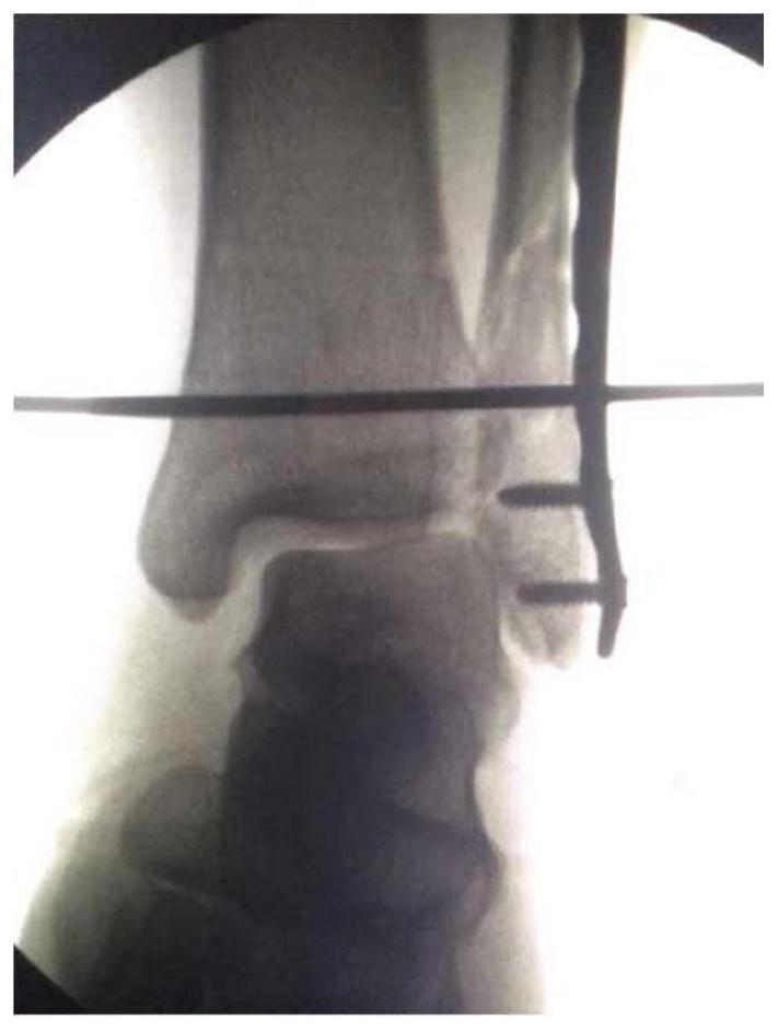 Distal tibiofibular joint screw guide forceps