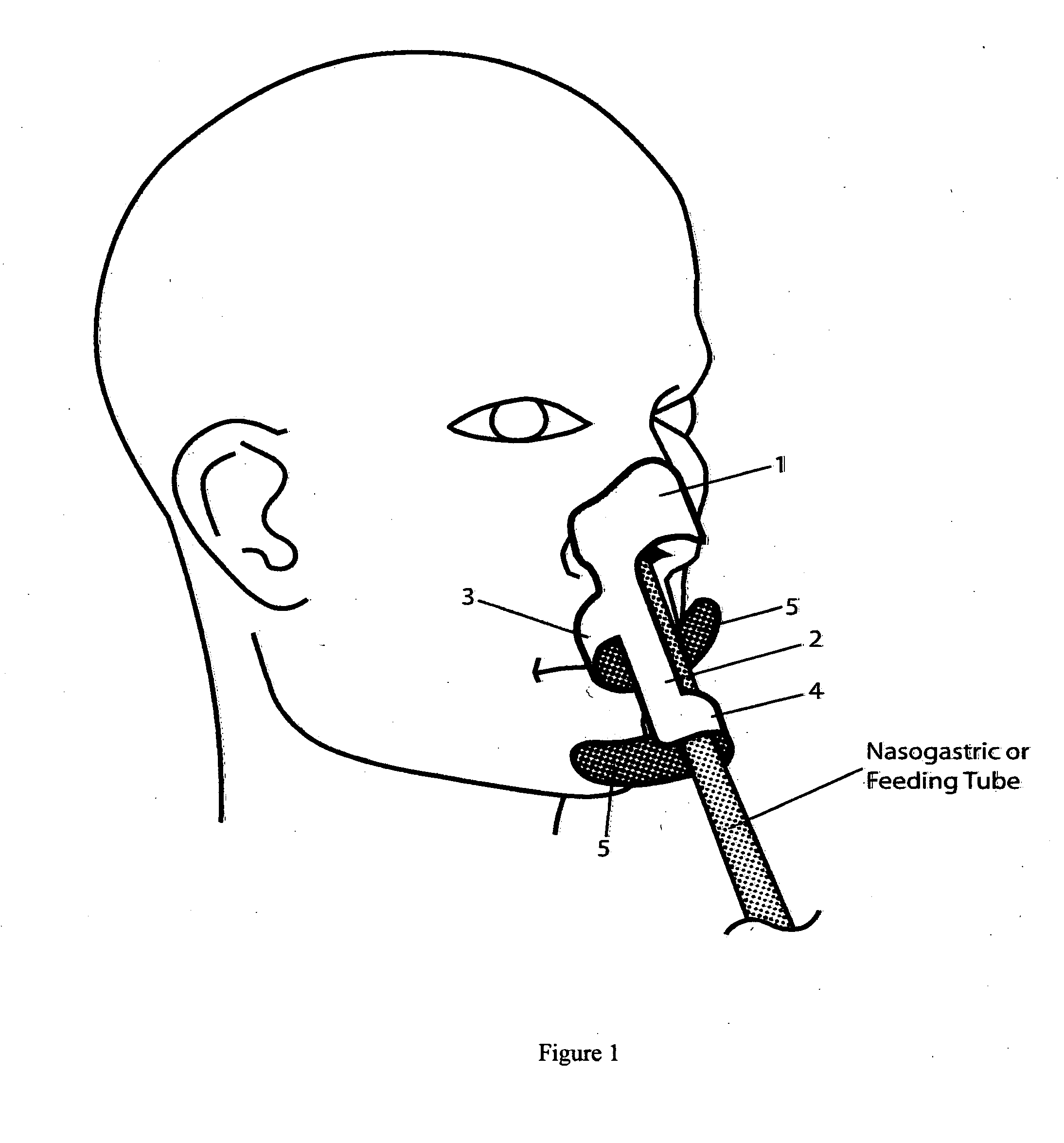 Nasogastric tube fastener