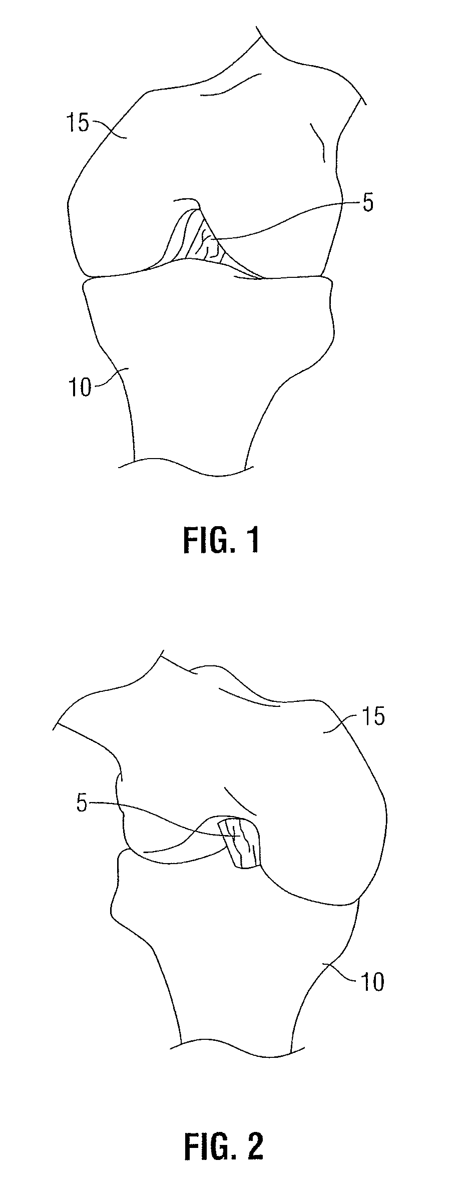 Femoral guide for ACL repair having adjustable offset