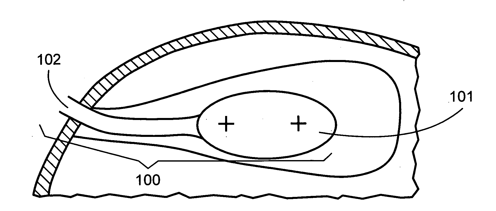 Brachytherapy apparatus and methods employing expandable medical devices comprising fixation elements