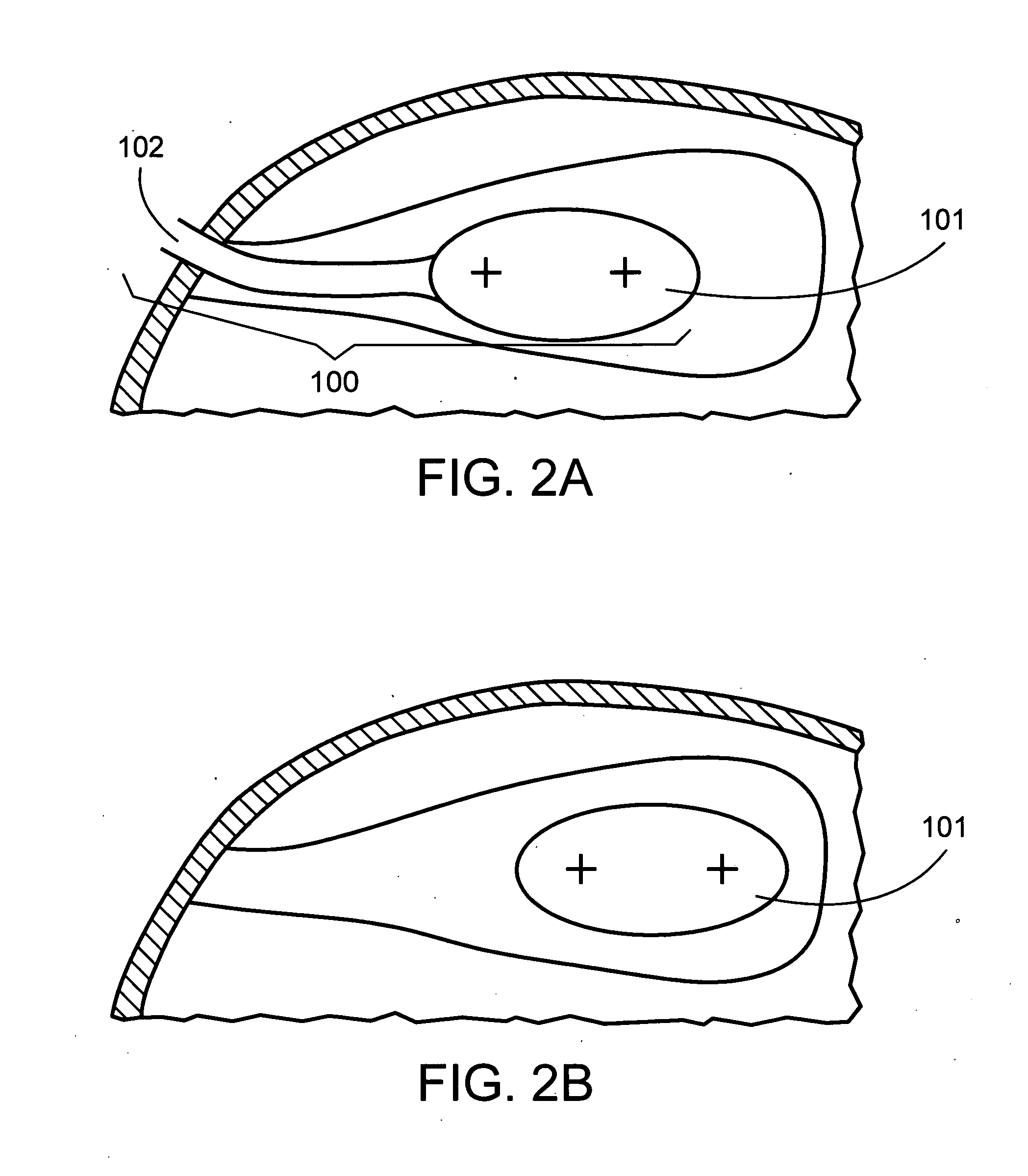 Brachytherapy apparatus and methods employing expandable medical devices comprising fixation elements