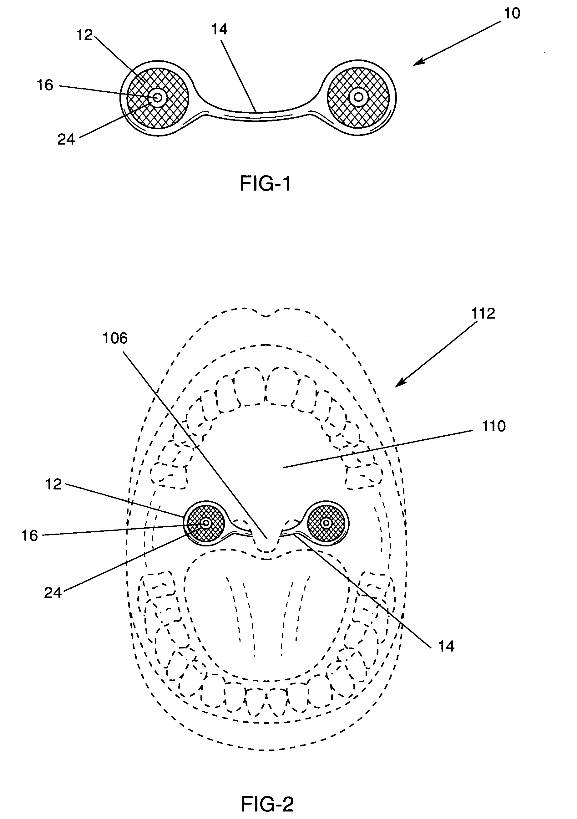 Anti-snoring apparatus and method