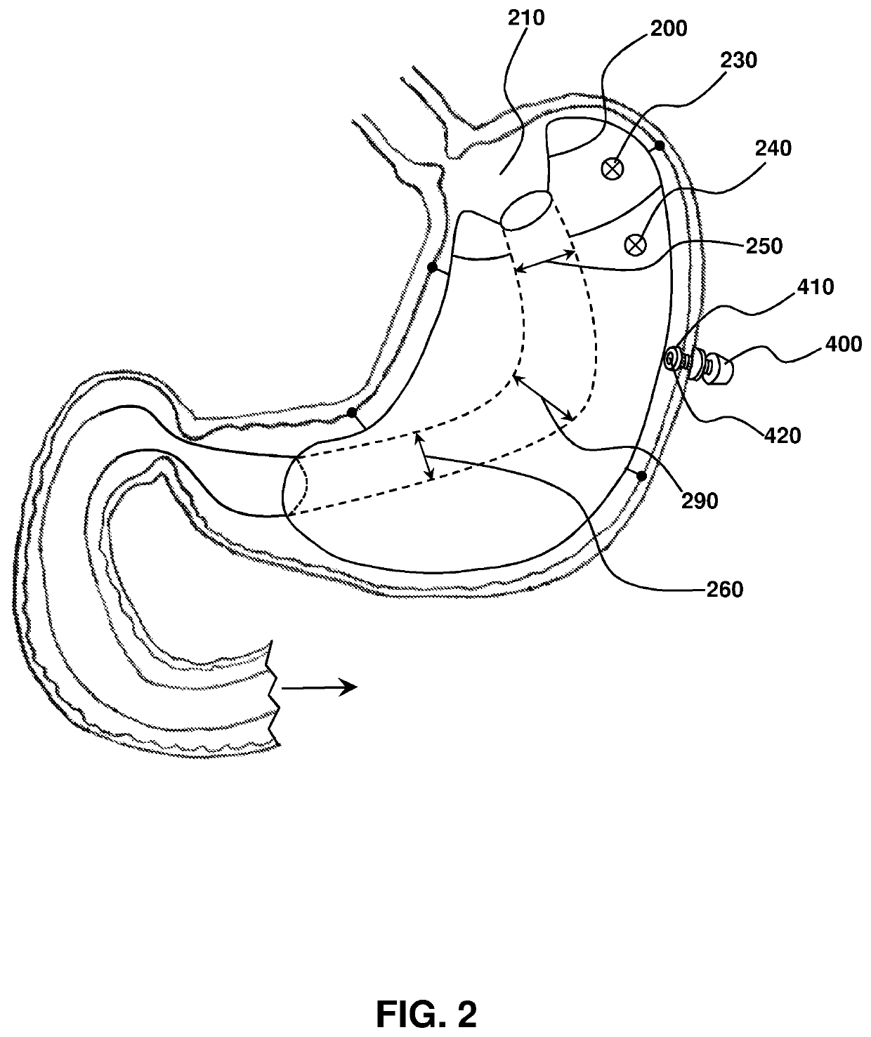 Sleeve-anchorable gastric balloon for weight loss