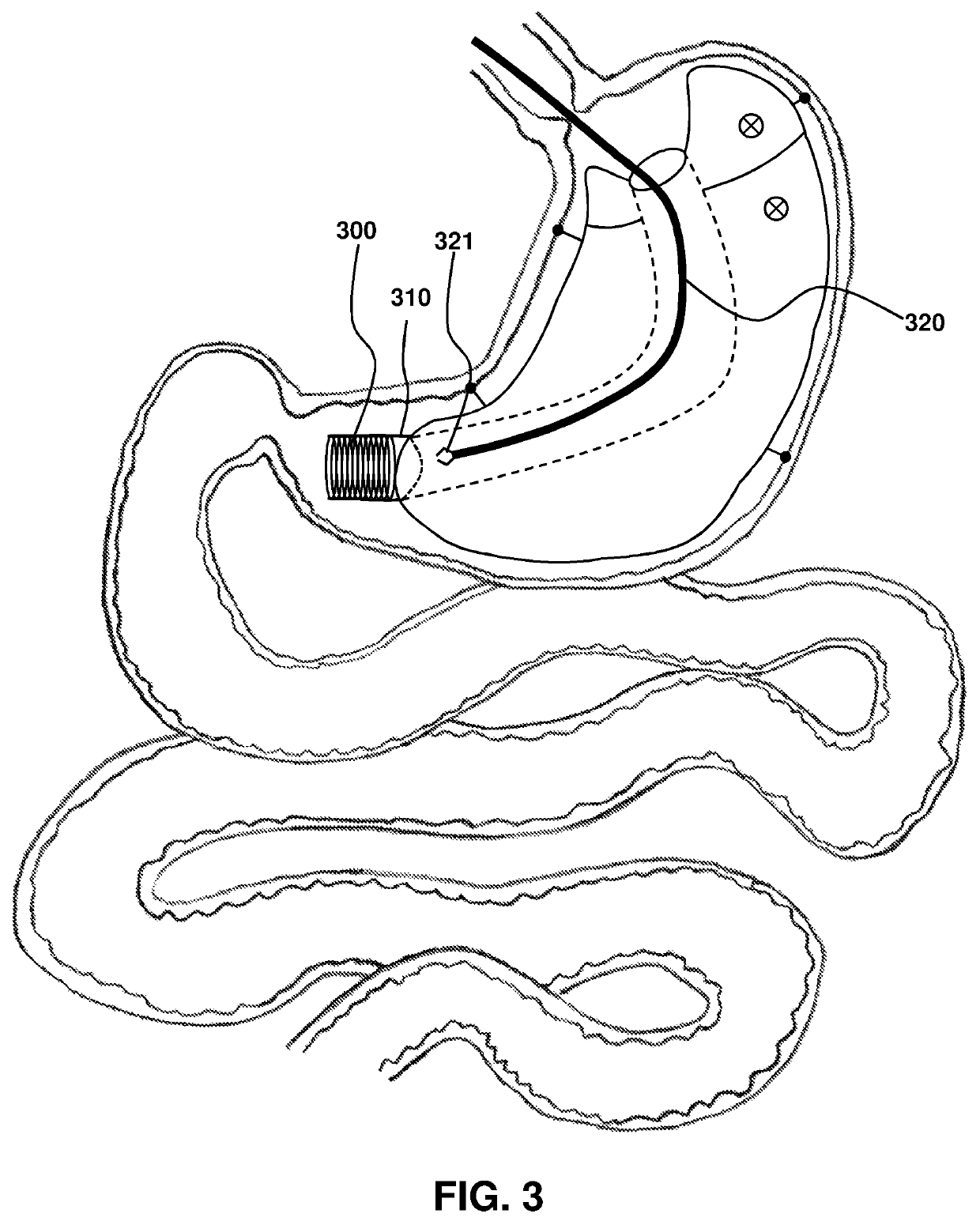 Sleeve-anchorable gastric balloon for weight loss