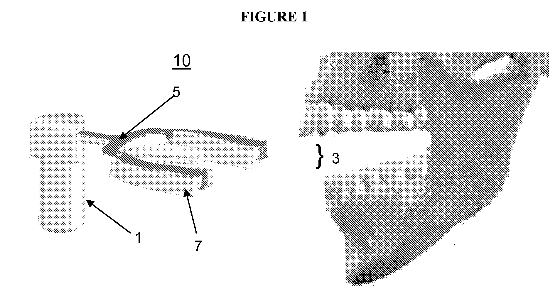 Vibrating compressible dental plate for correcting malocclusion