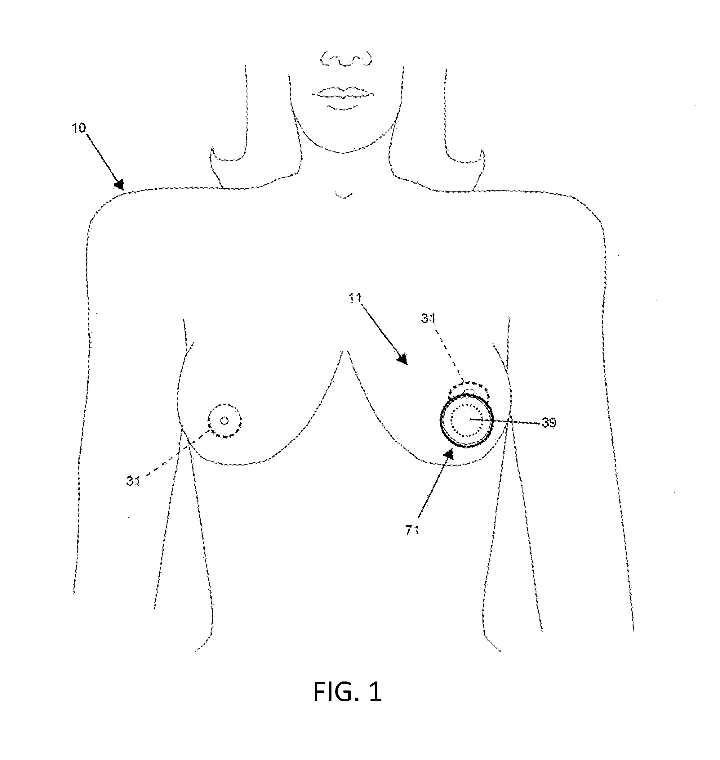 Circumferential wound retraction with support and guidance structures