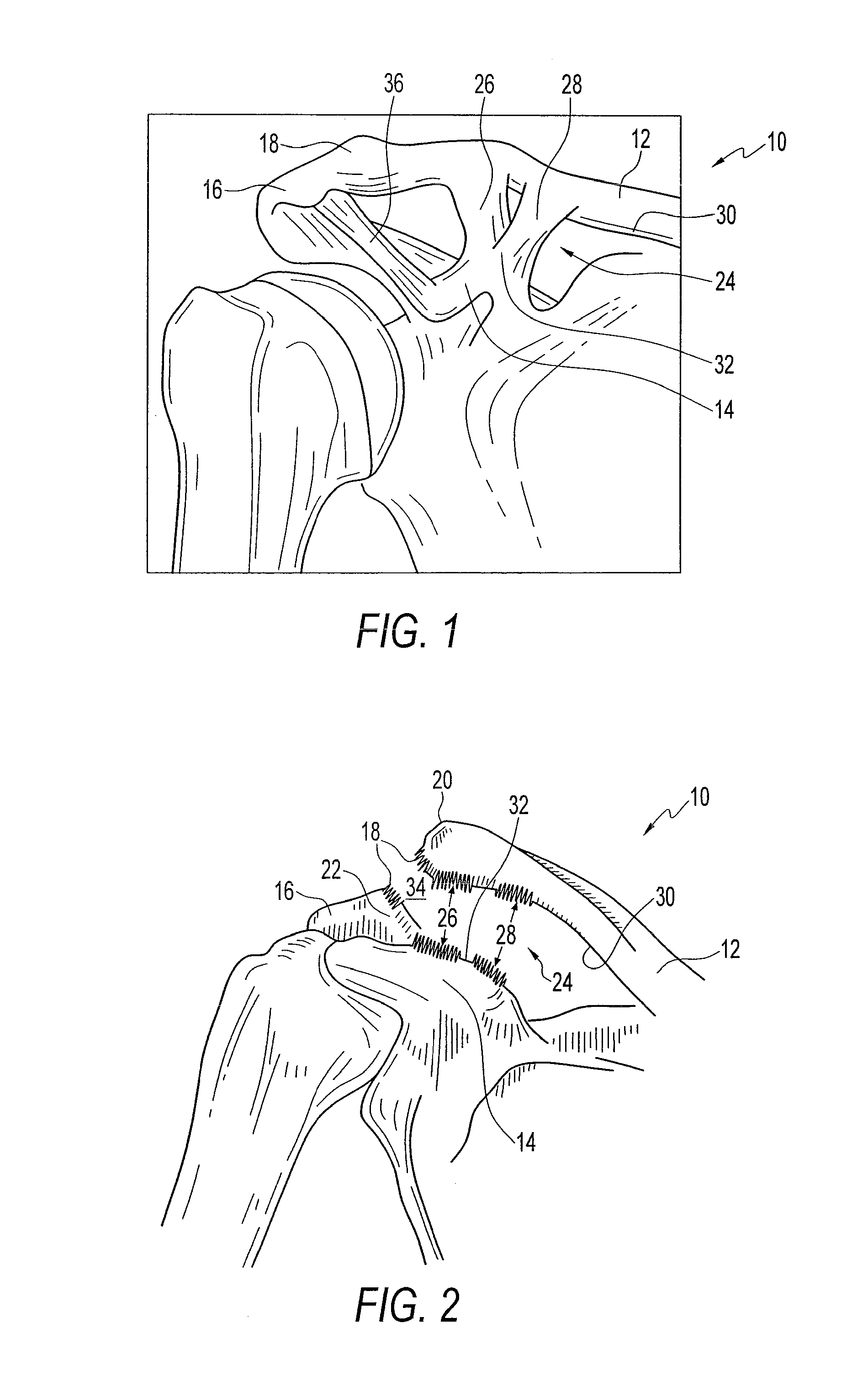 Method and apparatus for internal fixation of an acromioclavicular joint dislocation of the shoulder