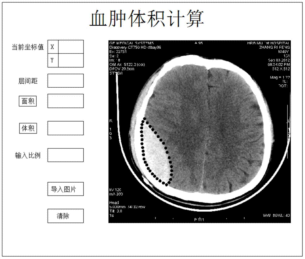 Application system for subdural hematoma volume calculation
