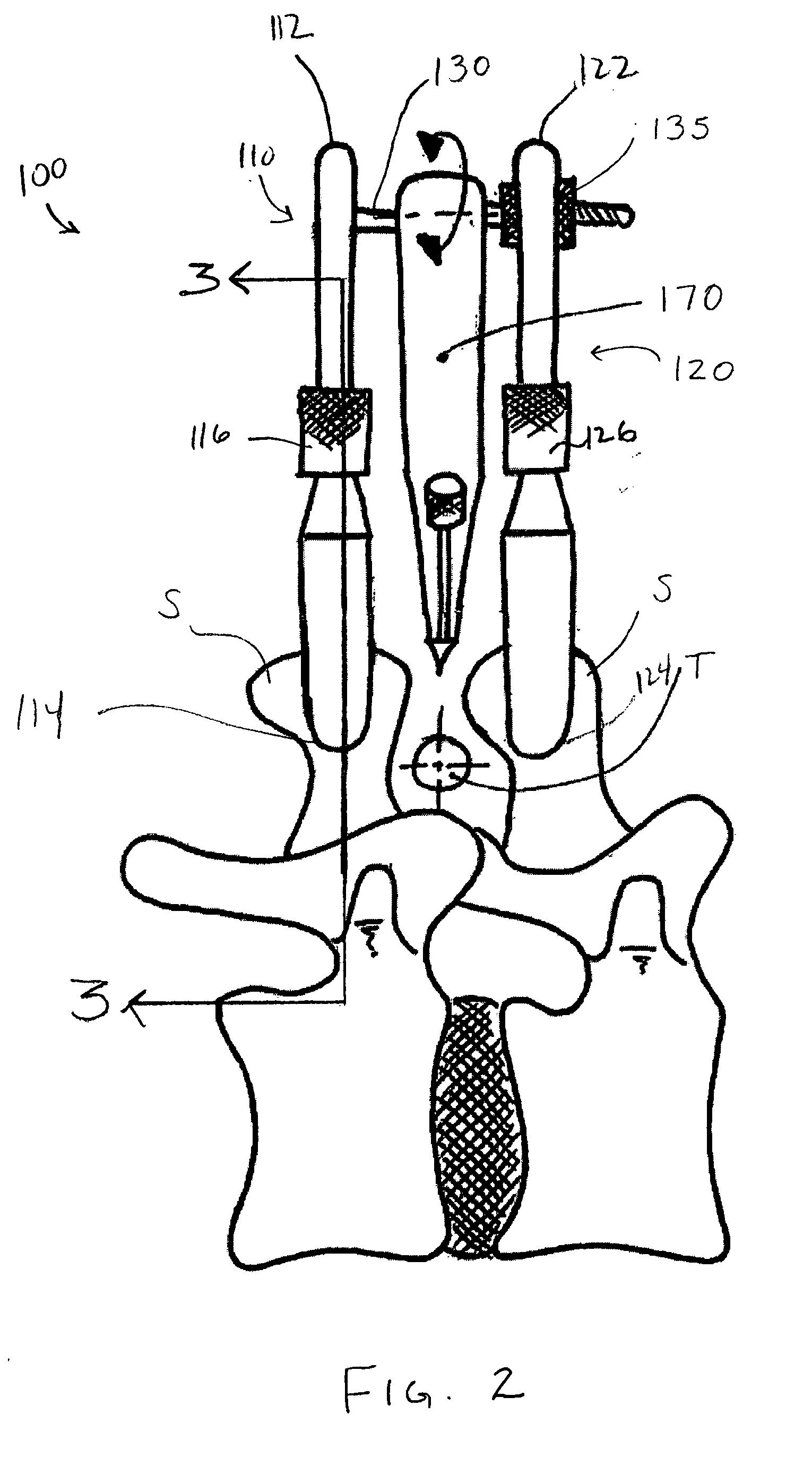 Apparatus and method for treatment of spinal conditions
