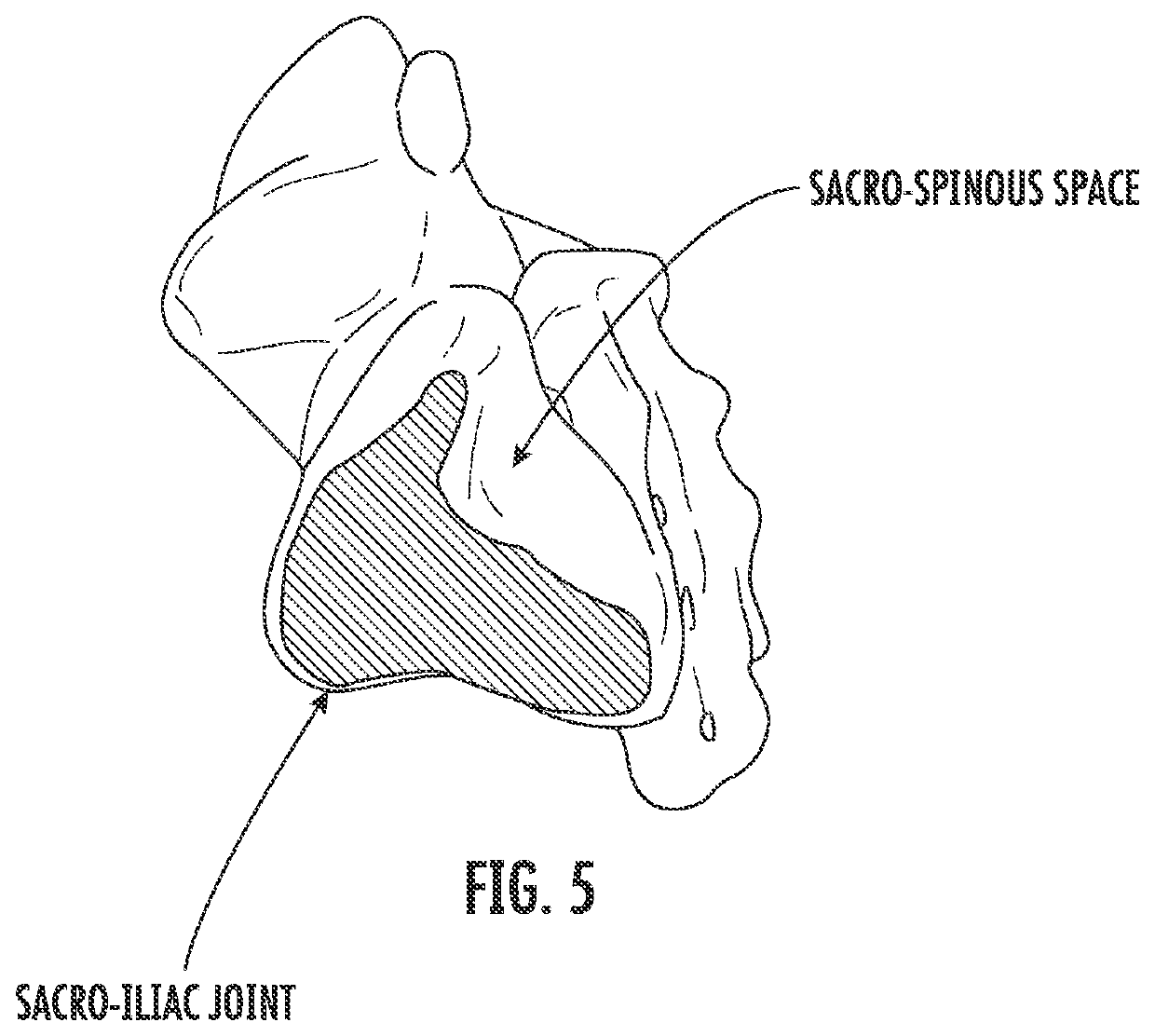 Method for performing spinal surgical procedures through the sacral ala