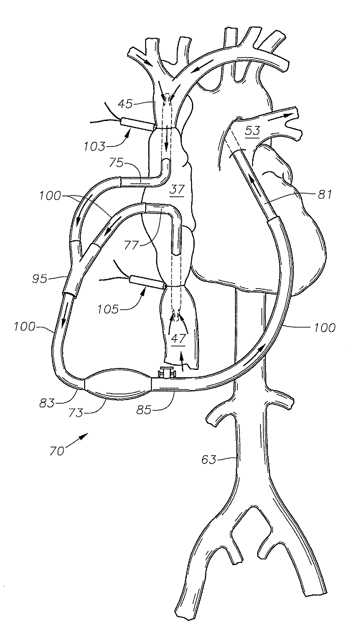 Heart pump apparatus and method for beating heart surgery