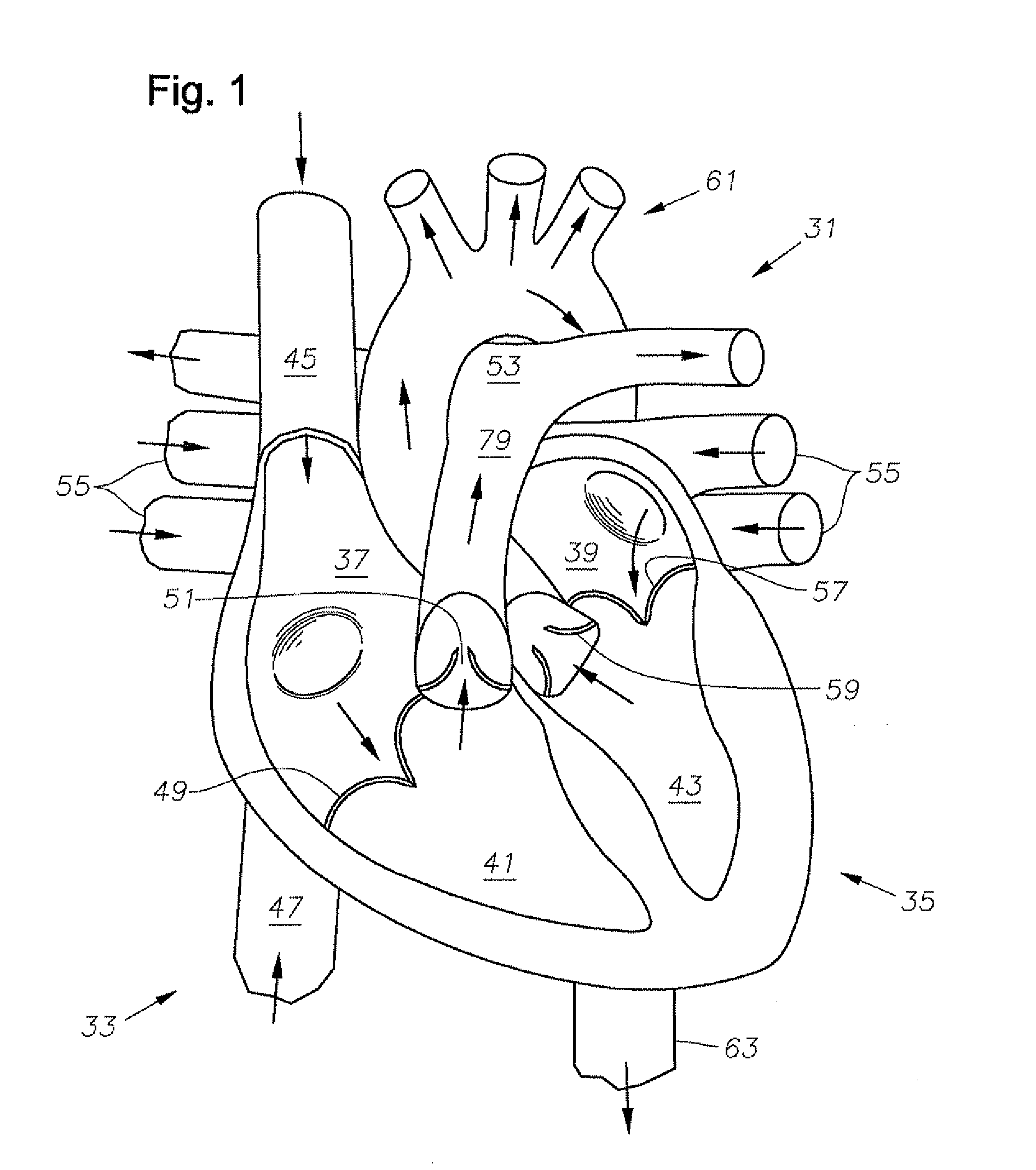 Heart pump apparatus and method for beating heart surgery