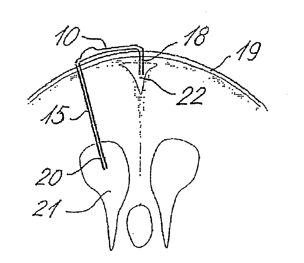 Method for shunting toxic substances from a brain ventricle to the sinus system