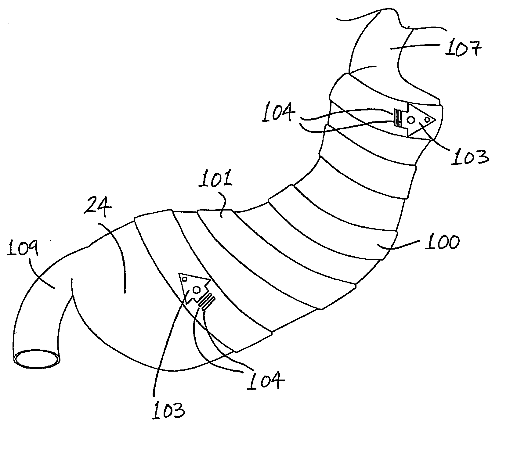 Gastric constriction device