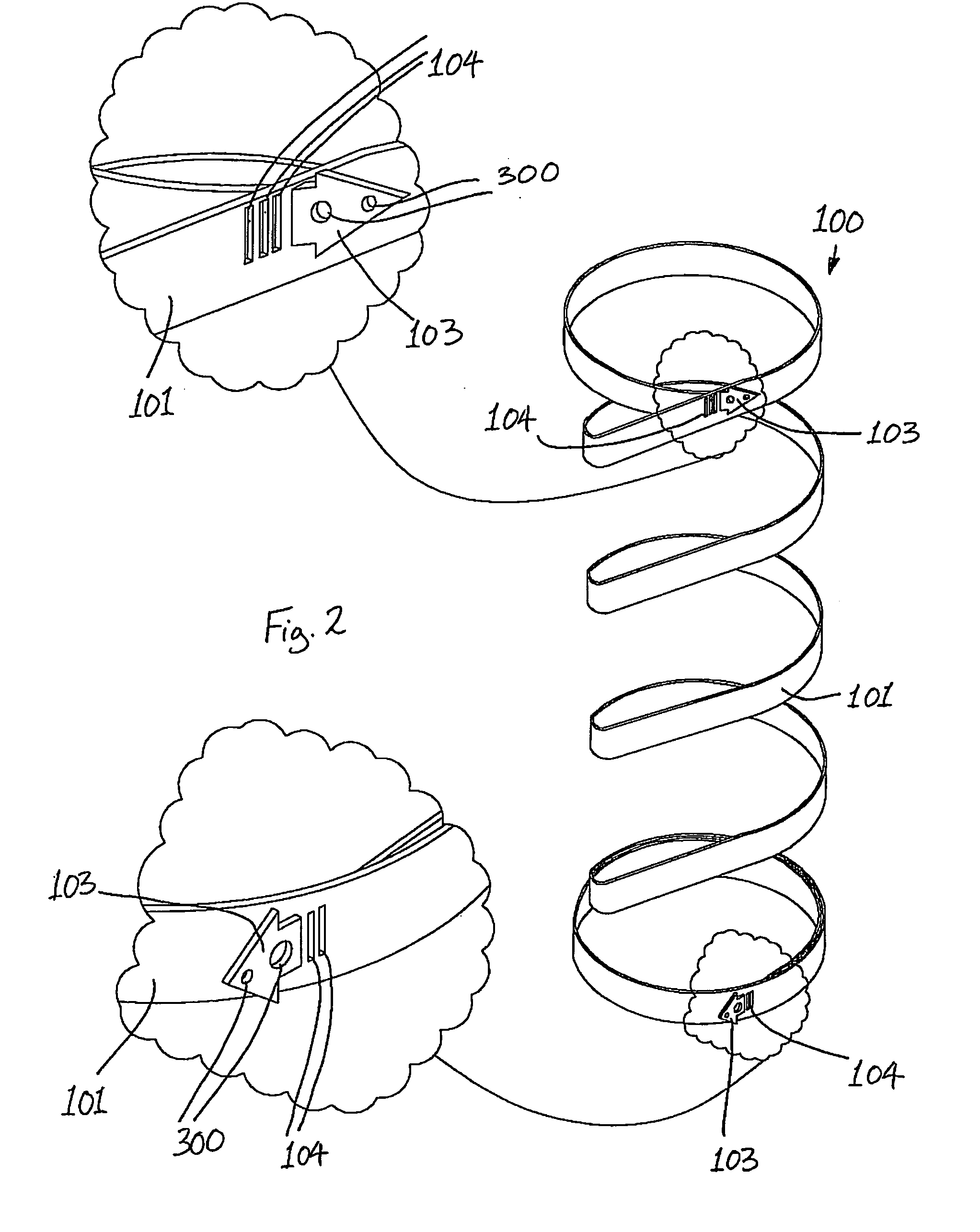 Gastric constriction device
