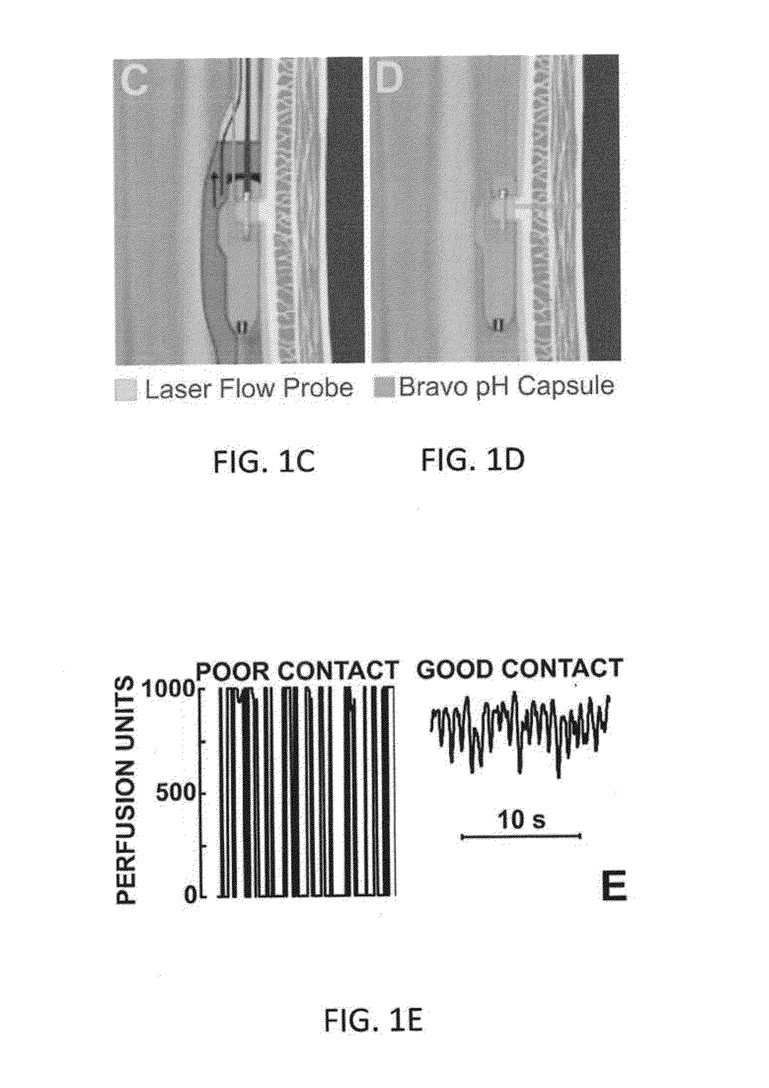 System, device and method for measurement of esophageal wall blood perfusion