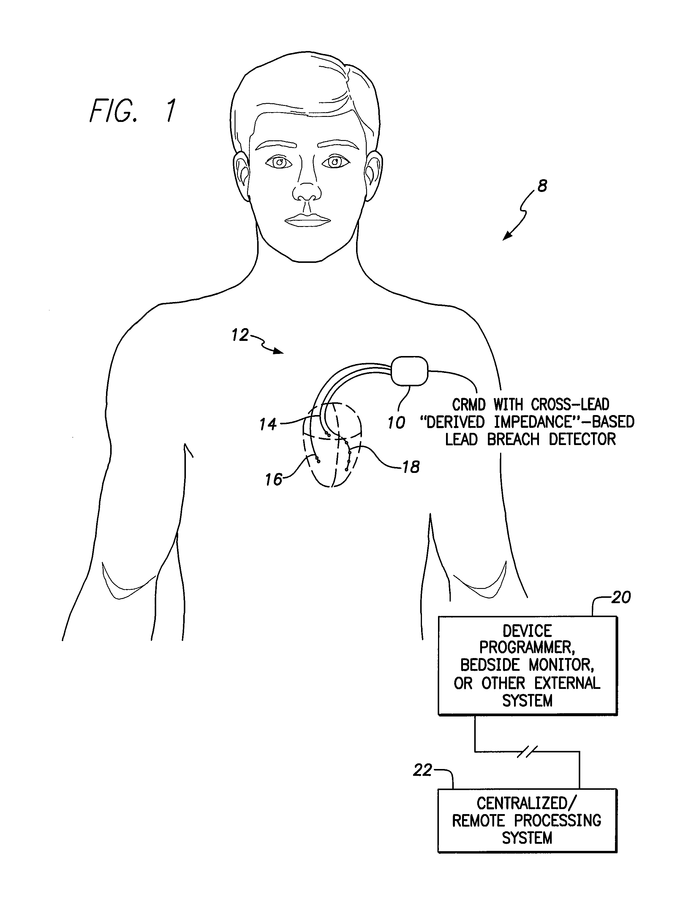 Systems and methods for early detection of lead breaches using cross-lead impedances detected by an implantable medical device