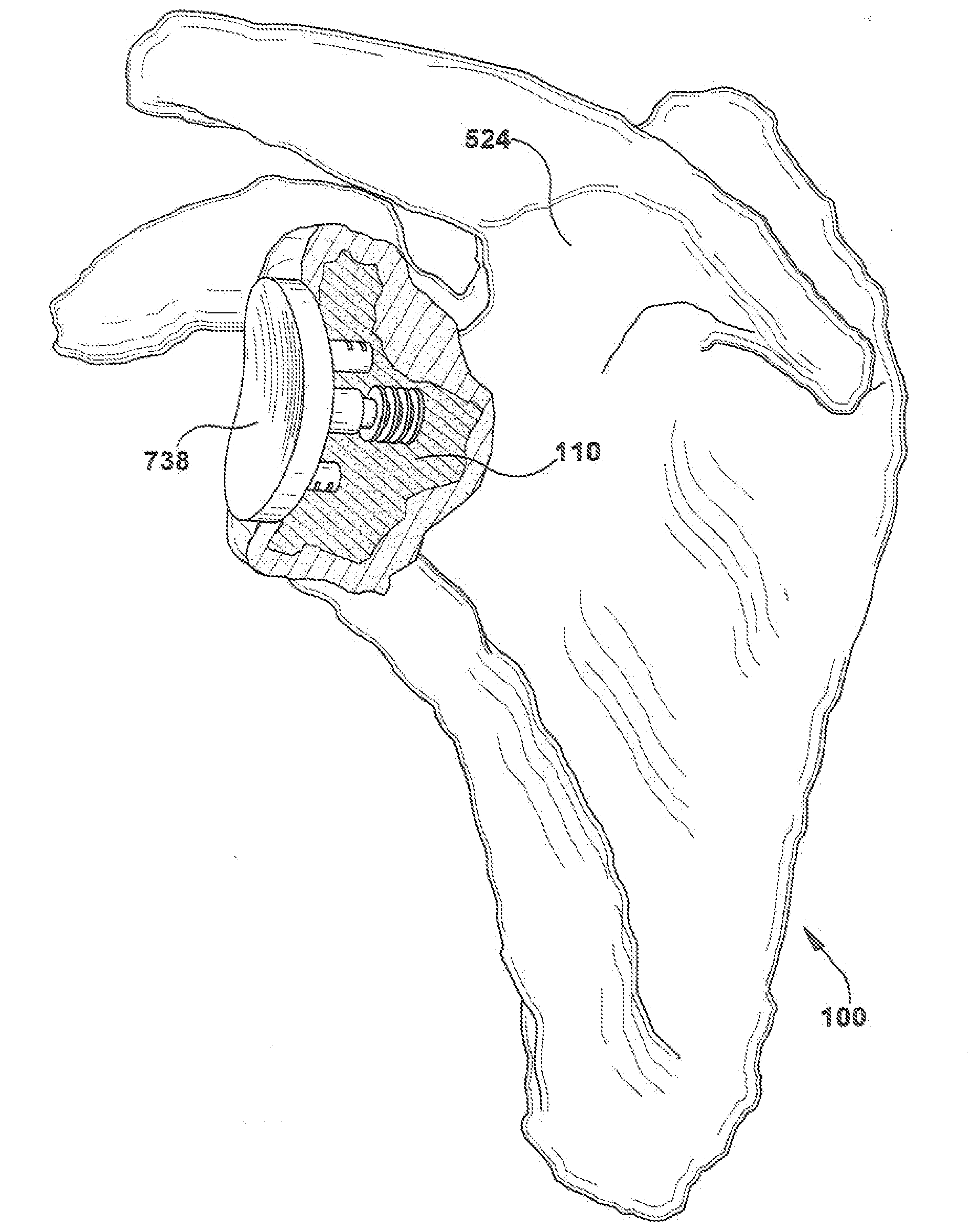 Method and apparatus for preparing for a surgical procedure