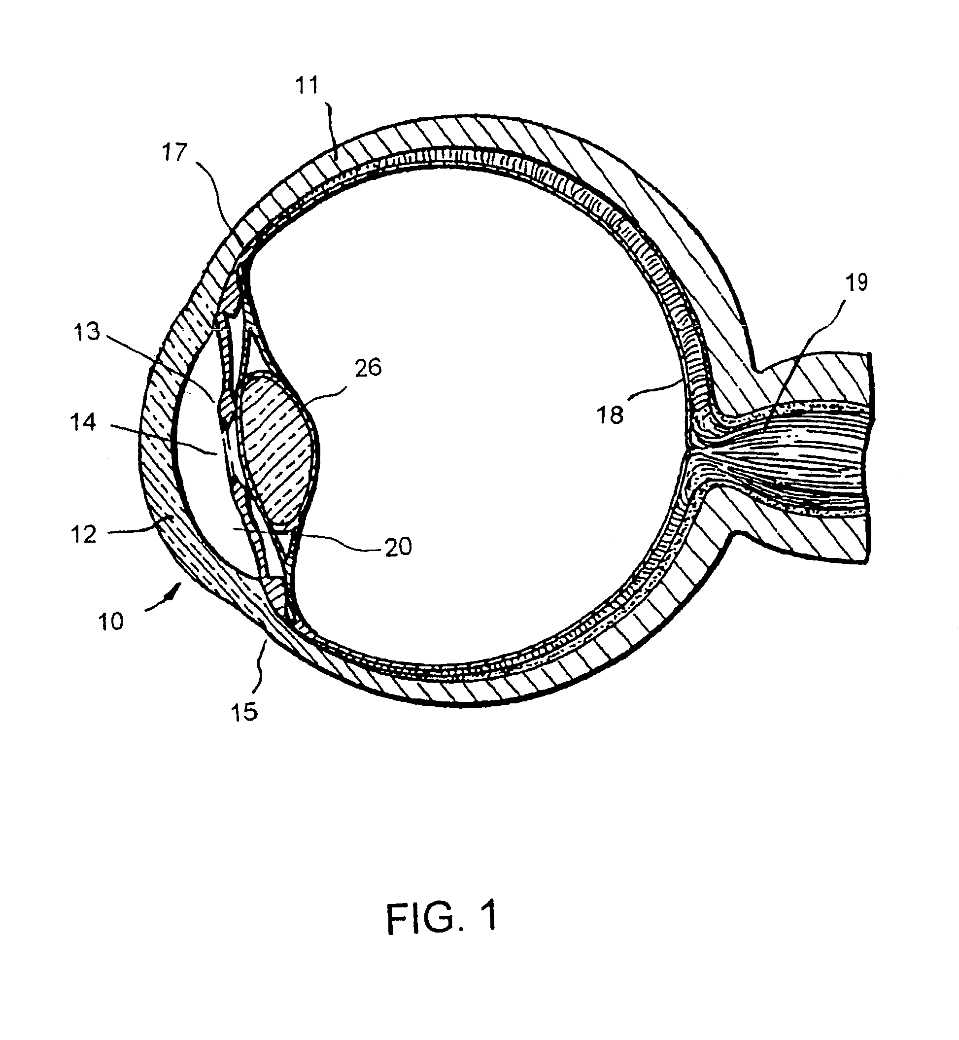 Fluid infusion methods for glaucoma treatment