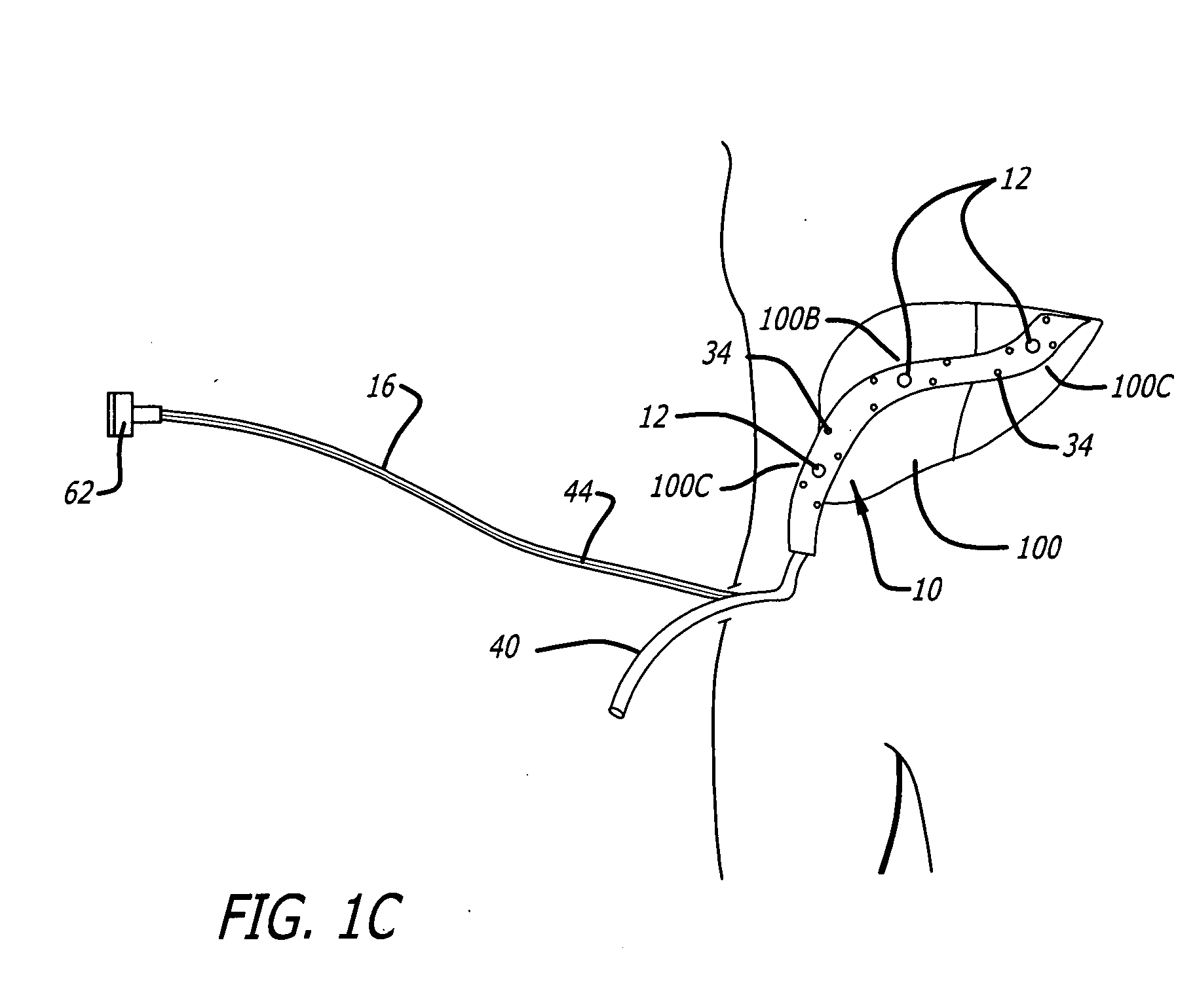 Surgical drain with sensors for monitoring internal tissue condition