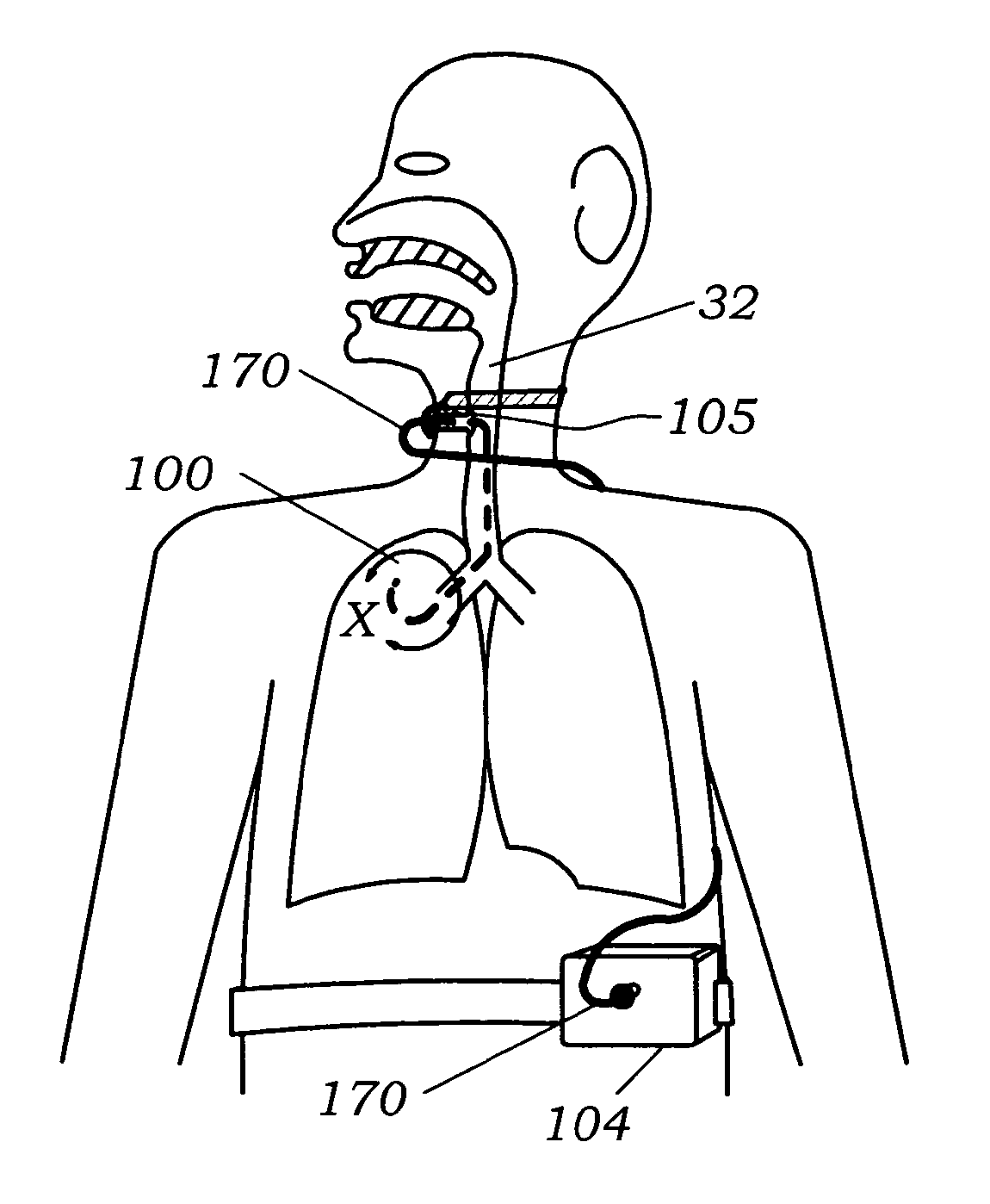 Methods, systems and devices for improving ventilation in a lung area