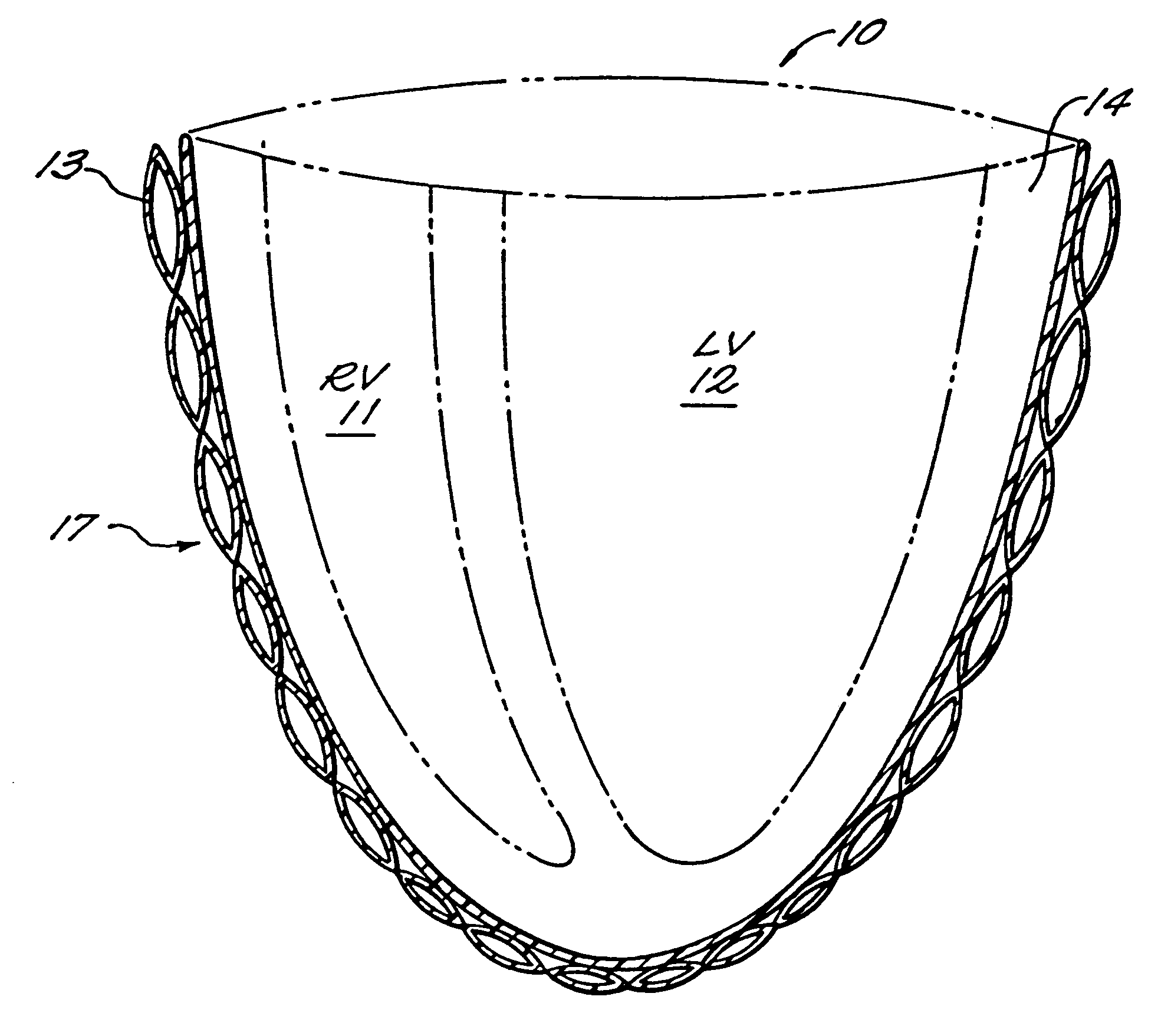 Passive girdle for heart ventricle for therapeutic aid to patients having ventricular dilatation