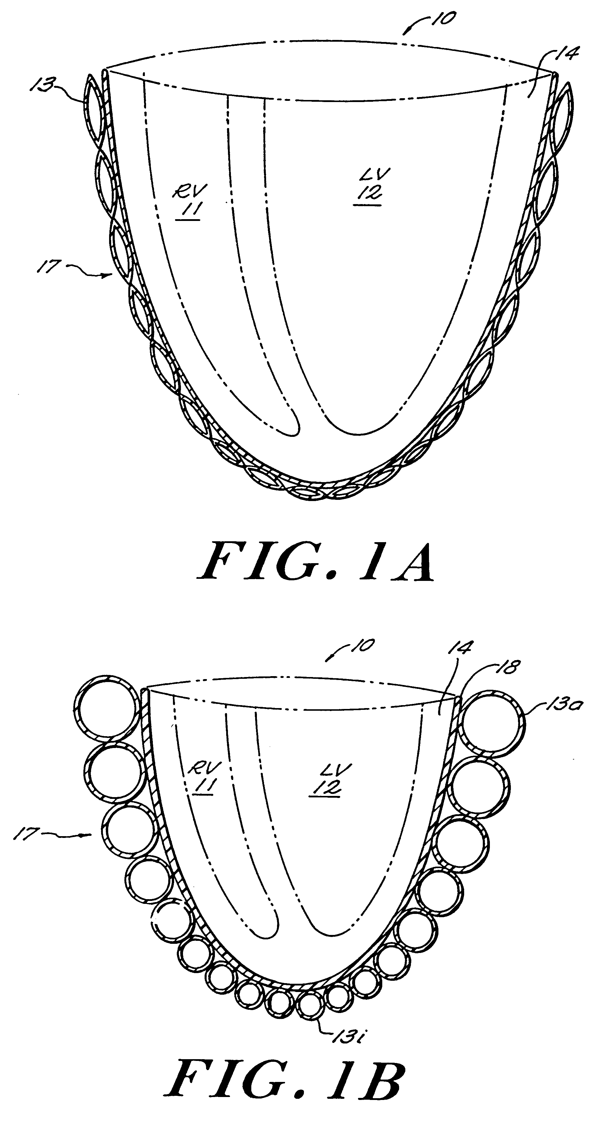 Passive girdle for heart ventricle for therapeutic aid to patients having ventricular dilatation