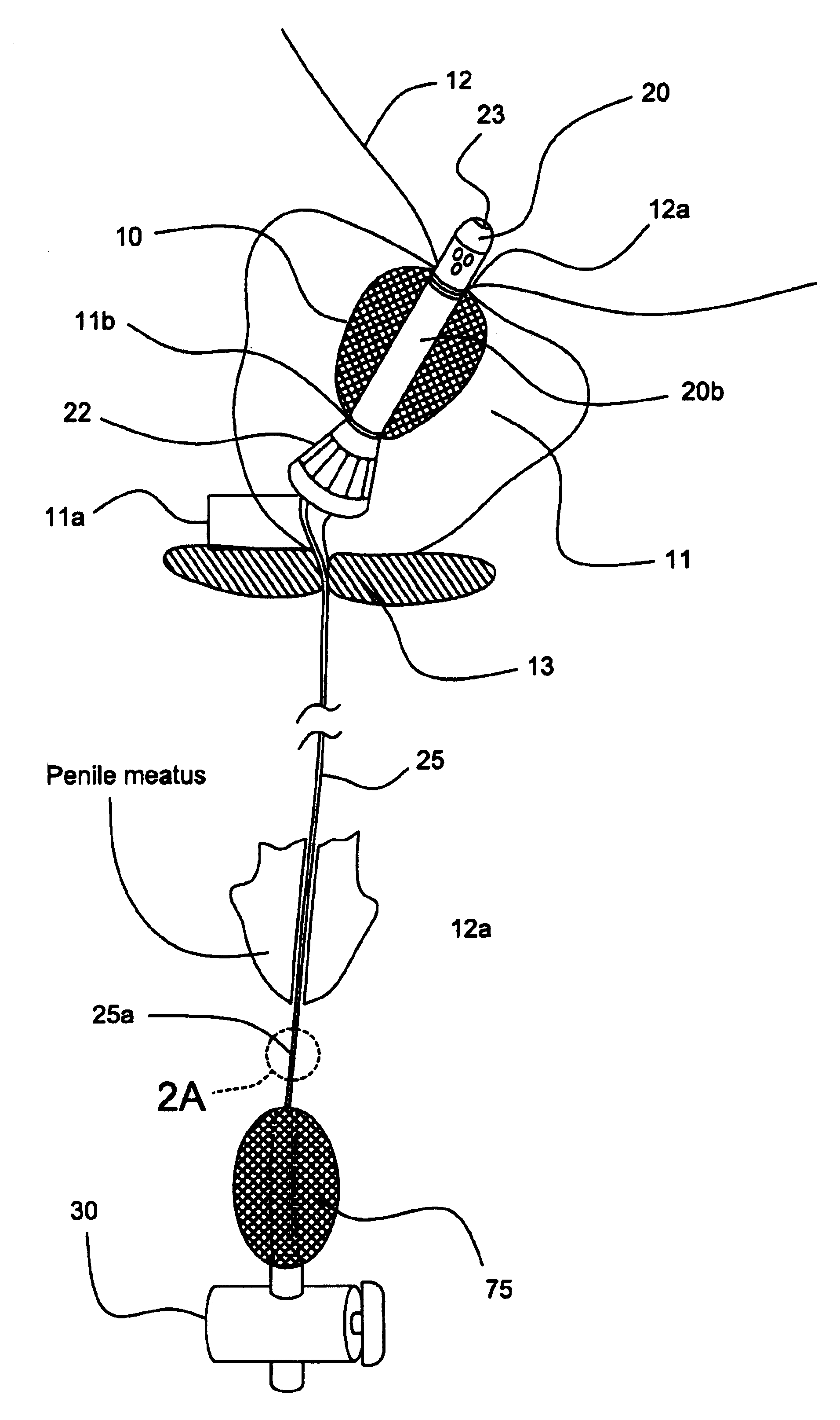 Prostatic stent with localized tissue engaging anchoring means and methods for inhibiting obstruction of the prostatic urethra