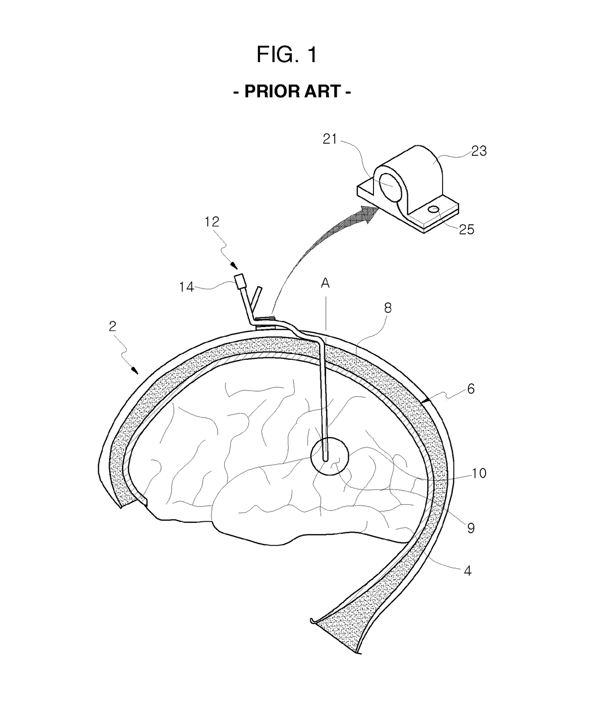 Catheter apparatus for cranial cavity