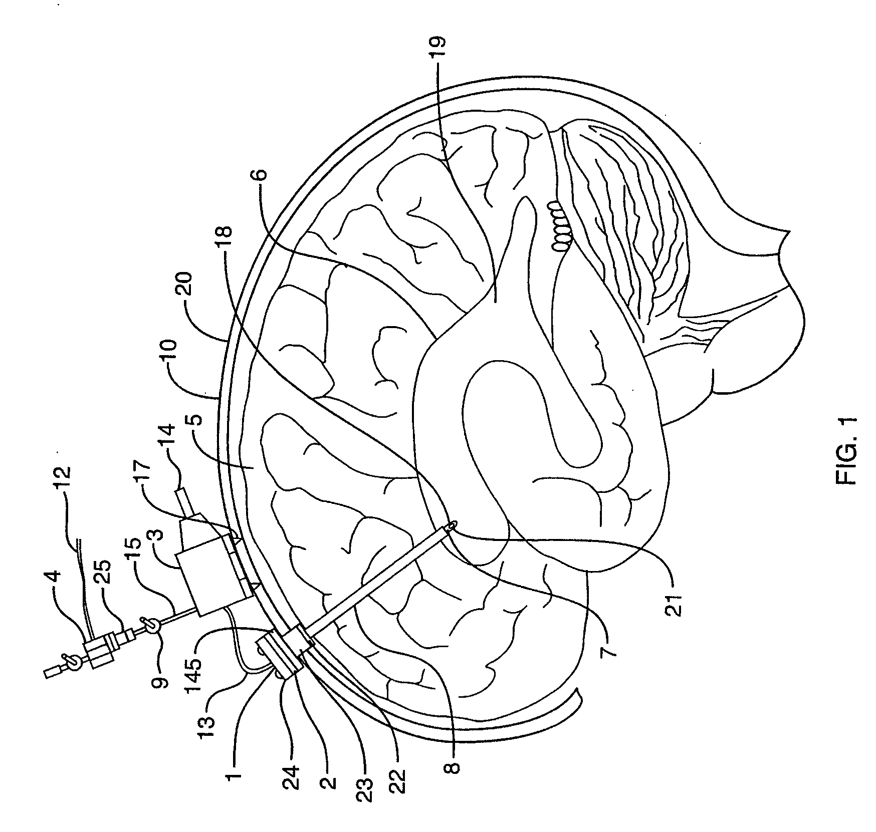 Method and device for reducing secondary brain injury