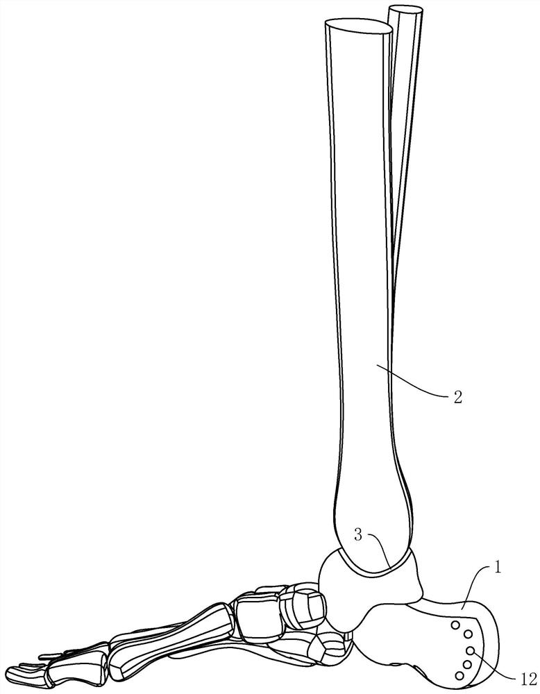 Calcaneus and talus prosthesis