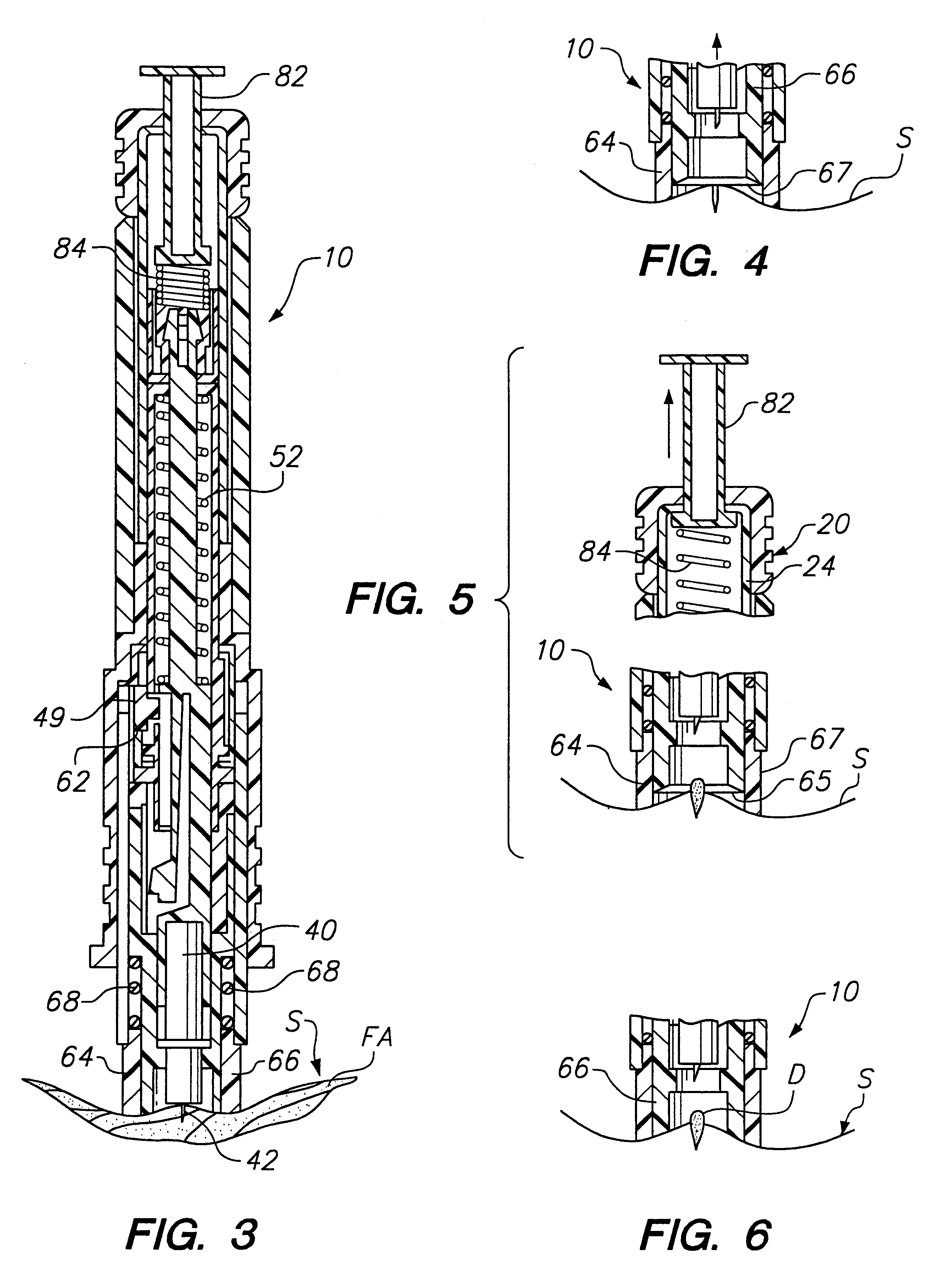 Apparatus for suctioning and pumping body fluid from an incision