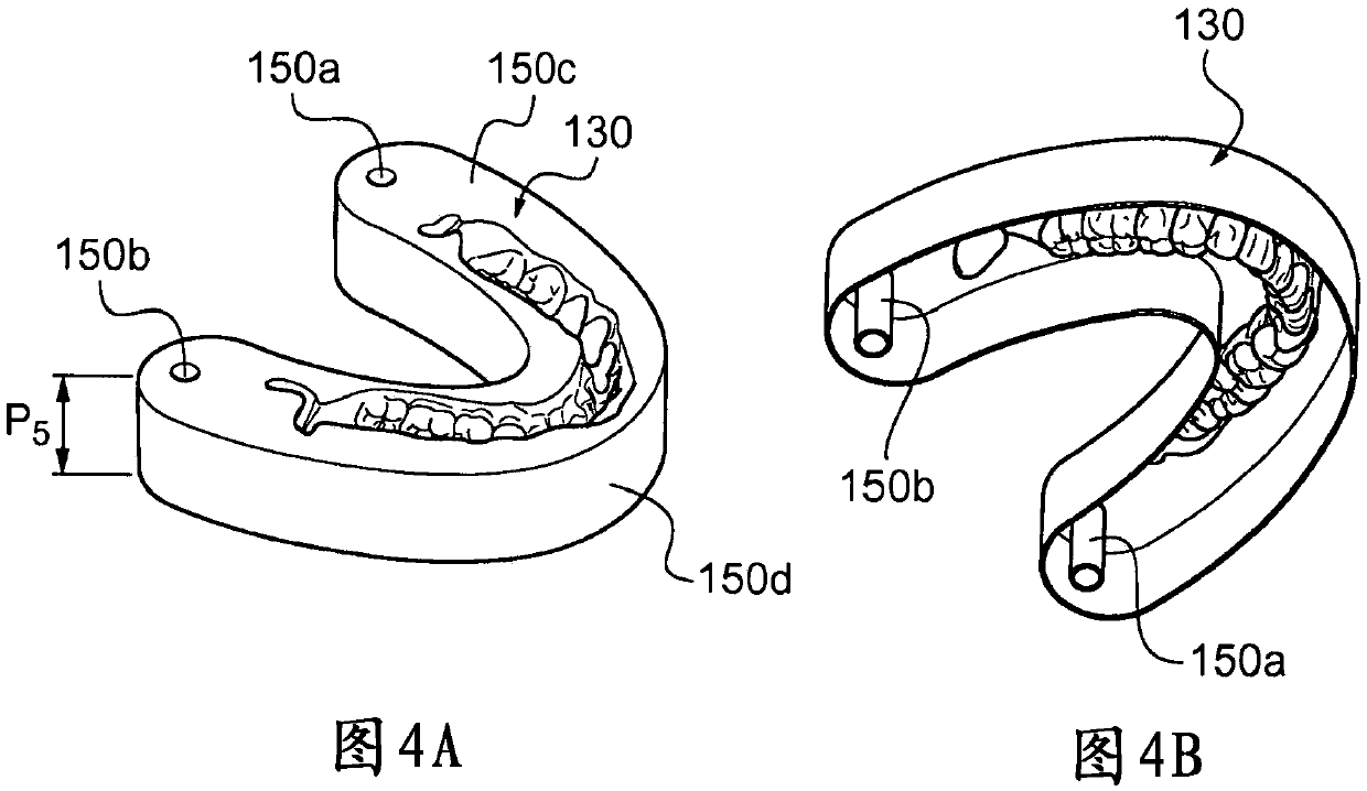 Method for manufacture of removable dental prosthesis by moulding with the aid of mould formed by additive manufacture