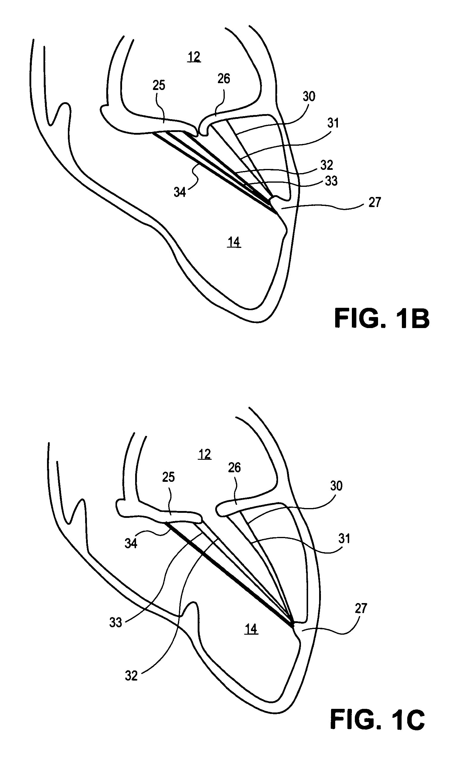 Heart valve chord cutter