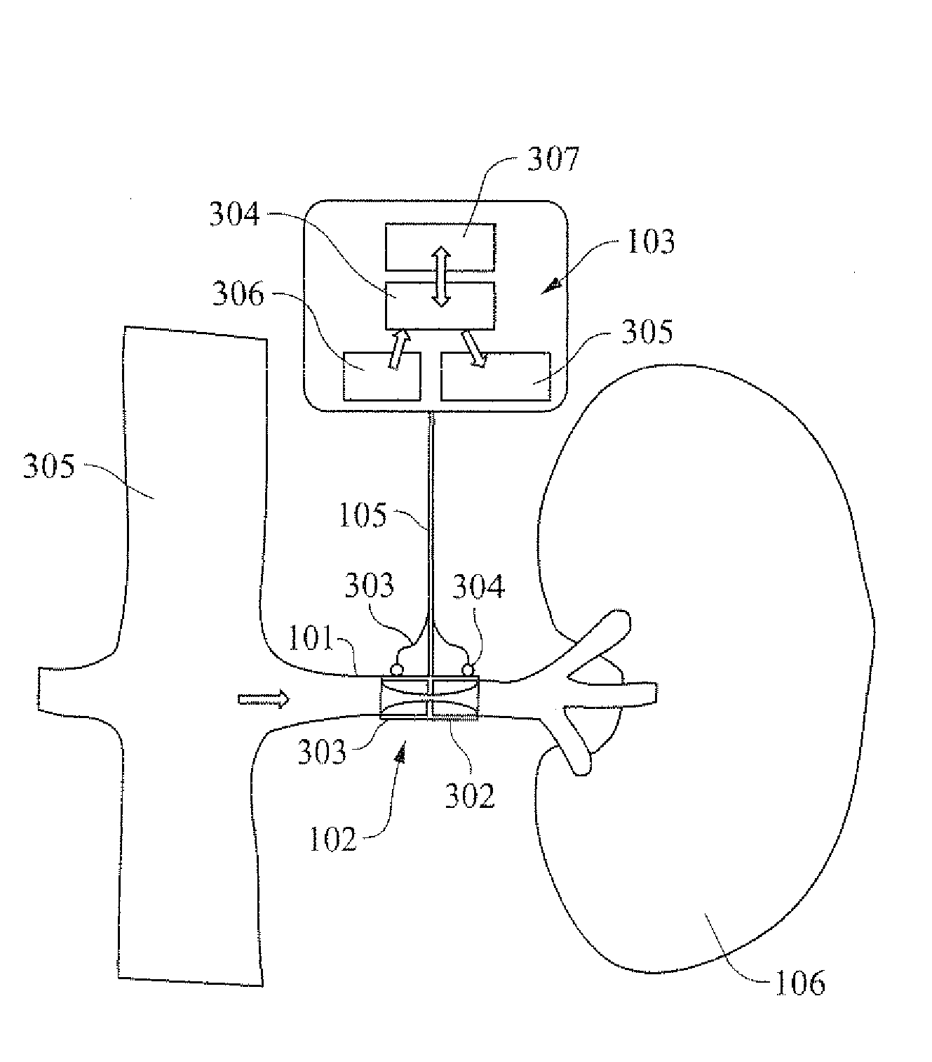Method and apparatus for reducing renal blood pressure
