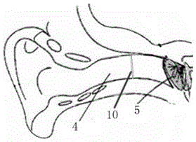 Tympanum puncture positioning device