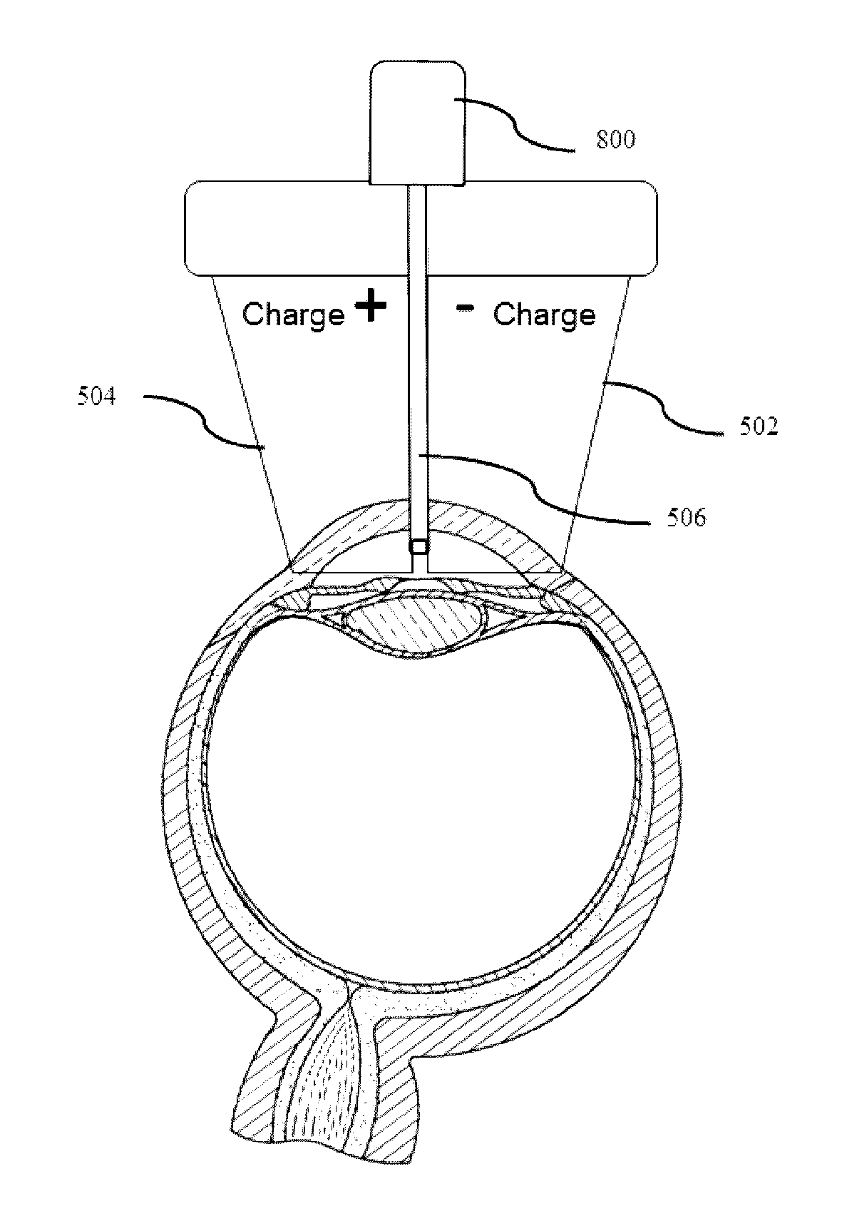 Devices and methods for treatment of ocular disorders through delivery of therapeutic nucleic acids