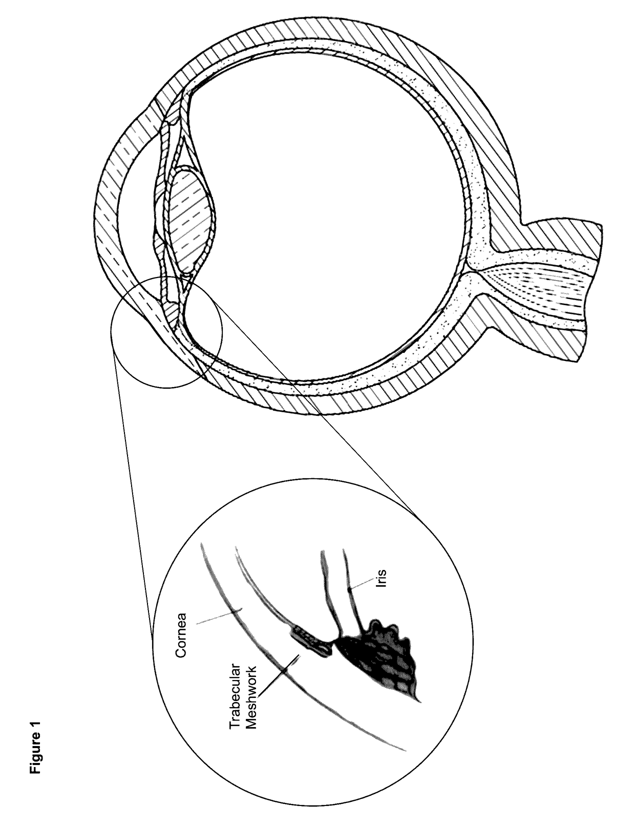 Devices and methods for treatment of ocular disorders through delivery of therapeutic nucleic acids