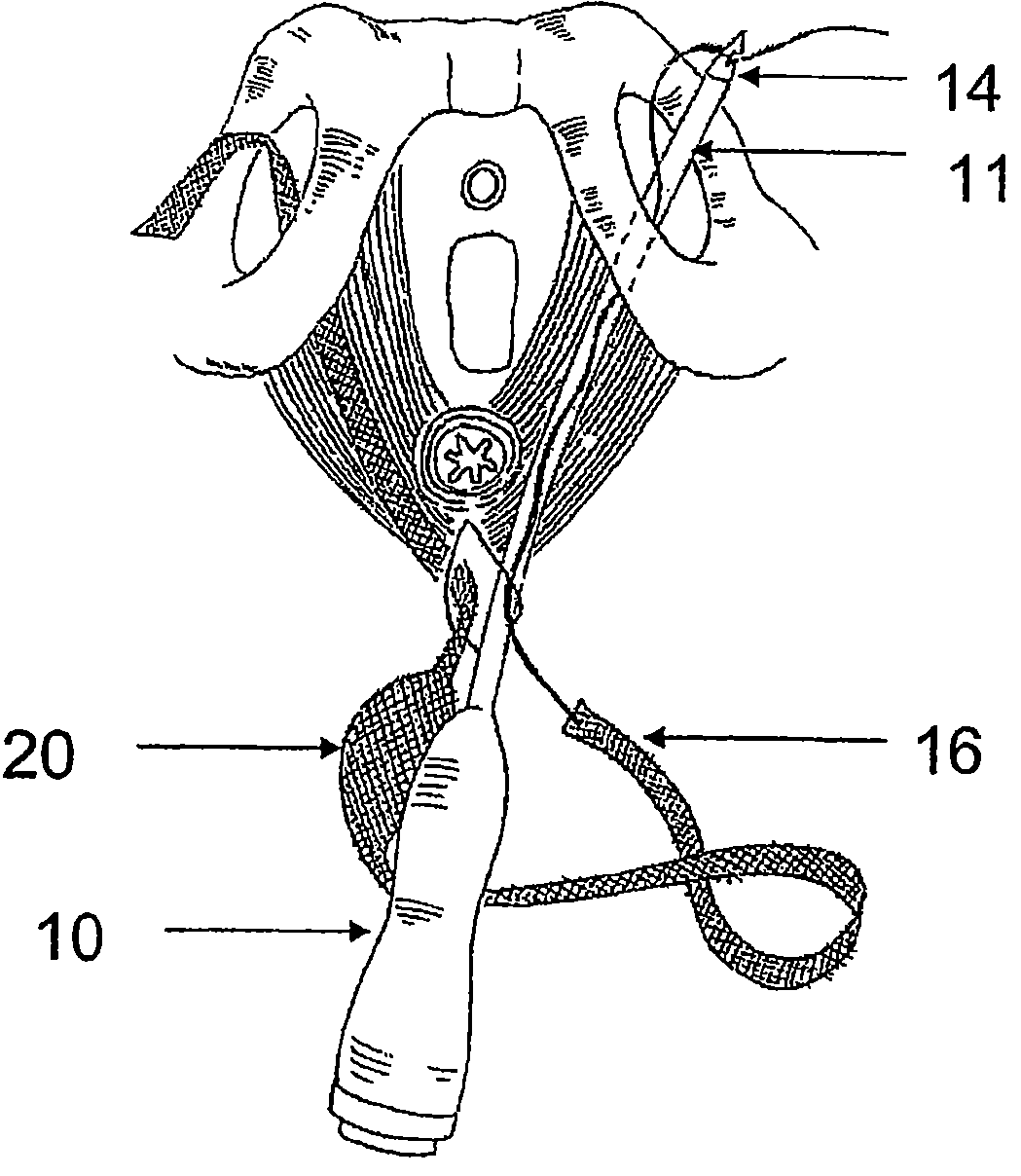 System and method for treatment of anal incontinence and pelvic organ prolapse