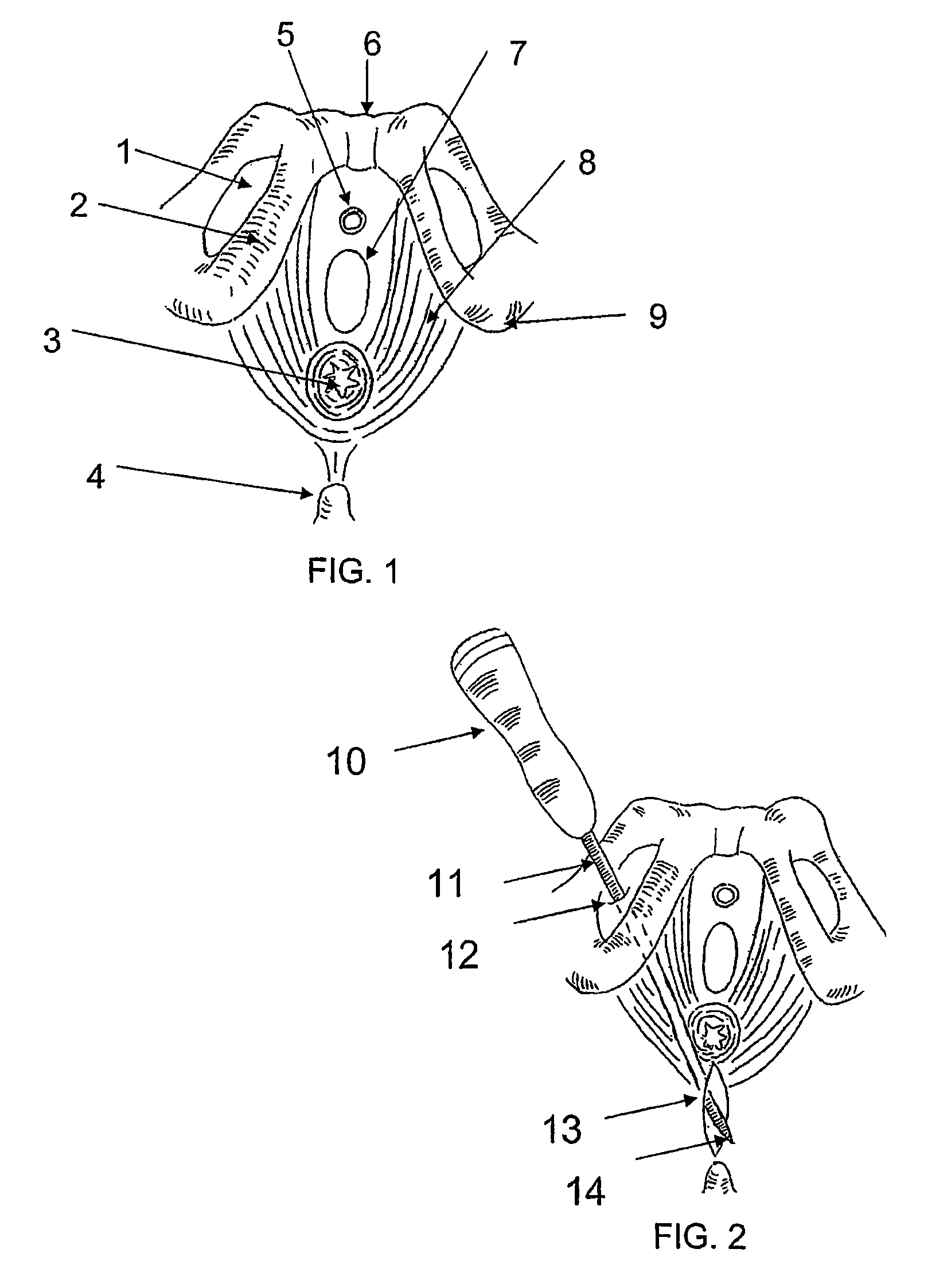 System and method for treatment of anal incontinence and pelvic organ prolapse