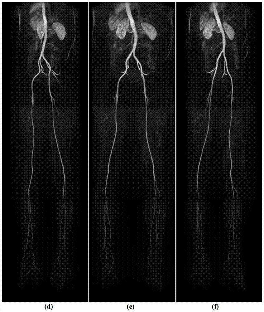 A Fast Registration and Stitching Method for 3D Digital Subtraction Angiography Images