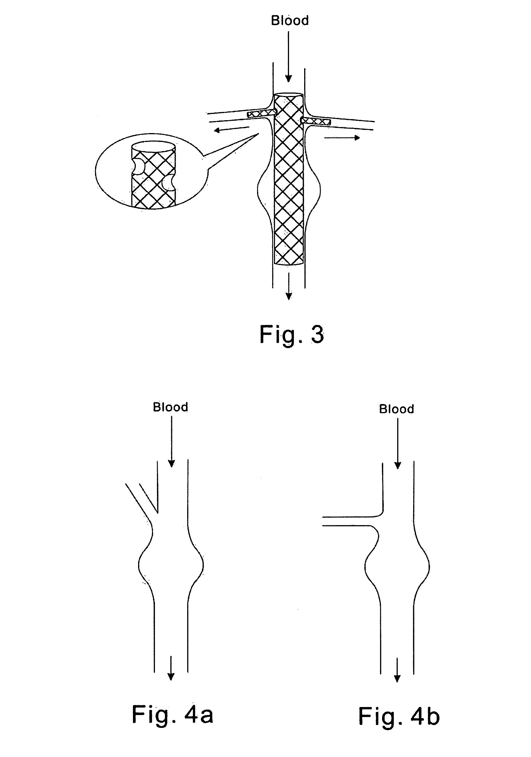Modular stent graft and delivery system