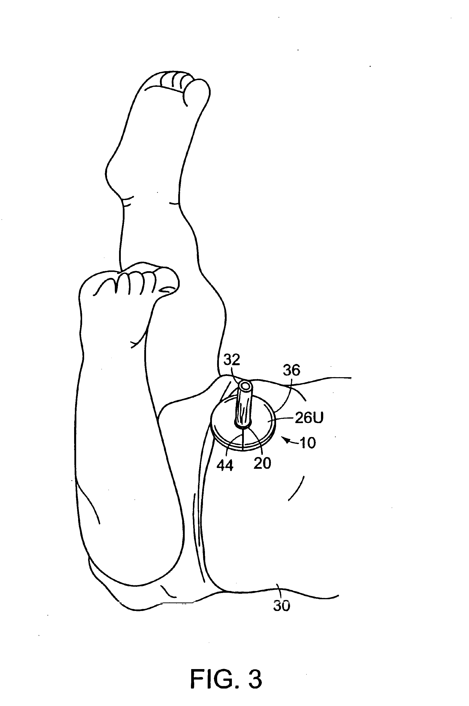Bandage for protection of skin surrounding an umbilical cord stump