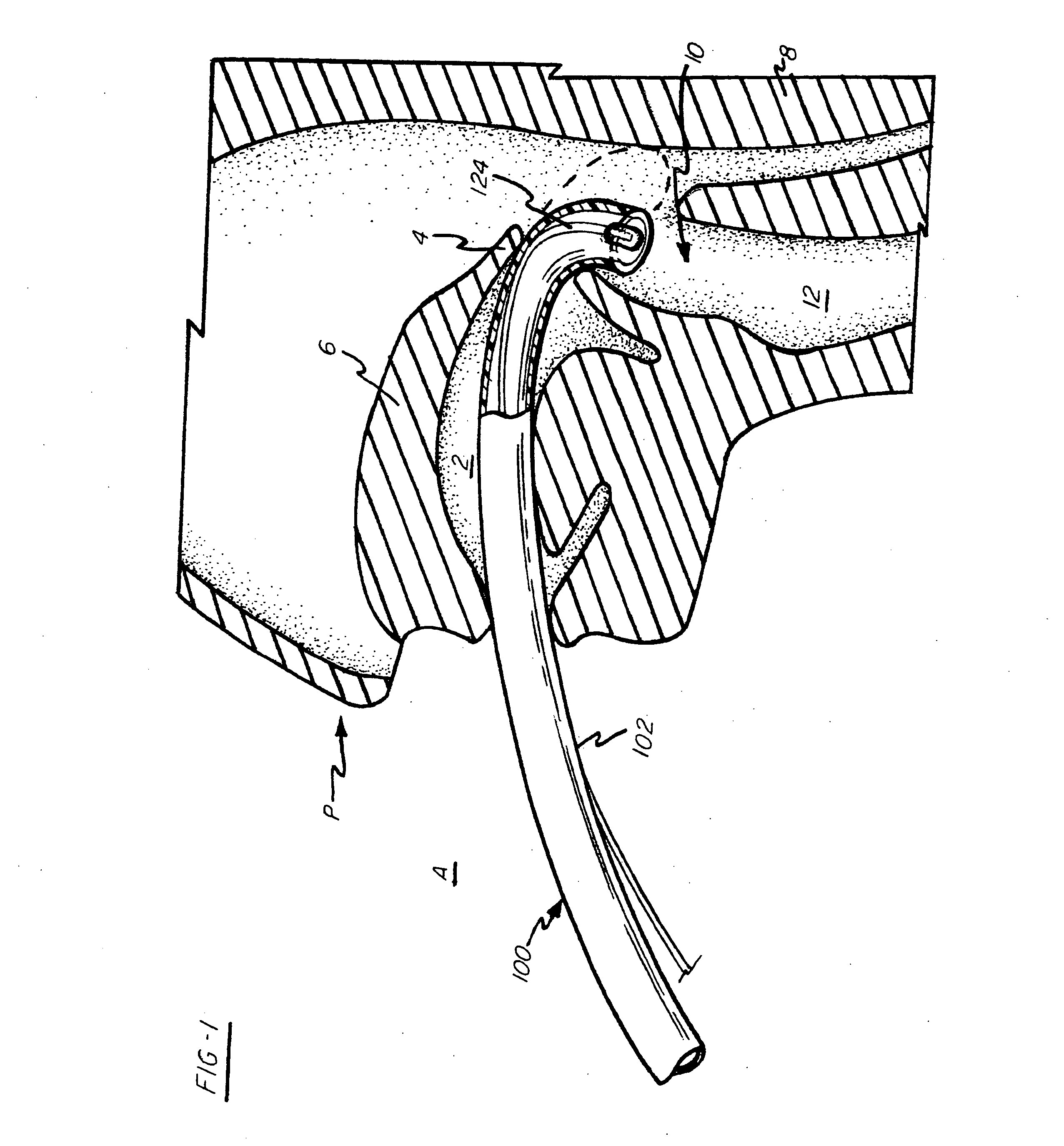 Intubation device and method of use