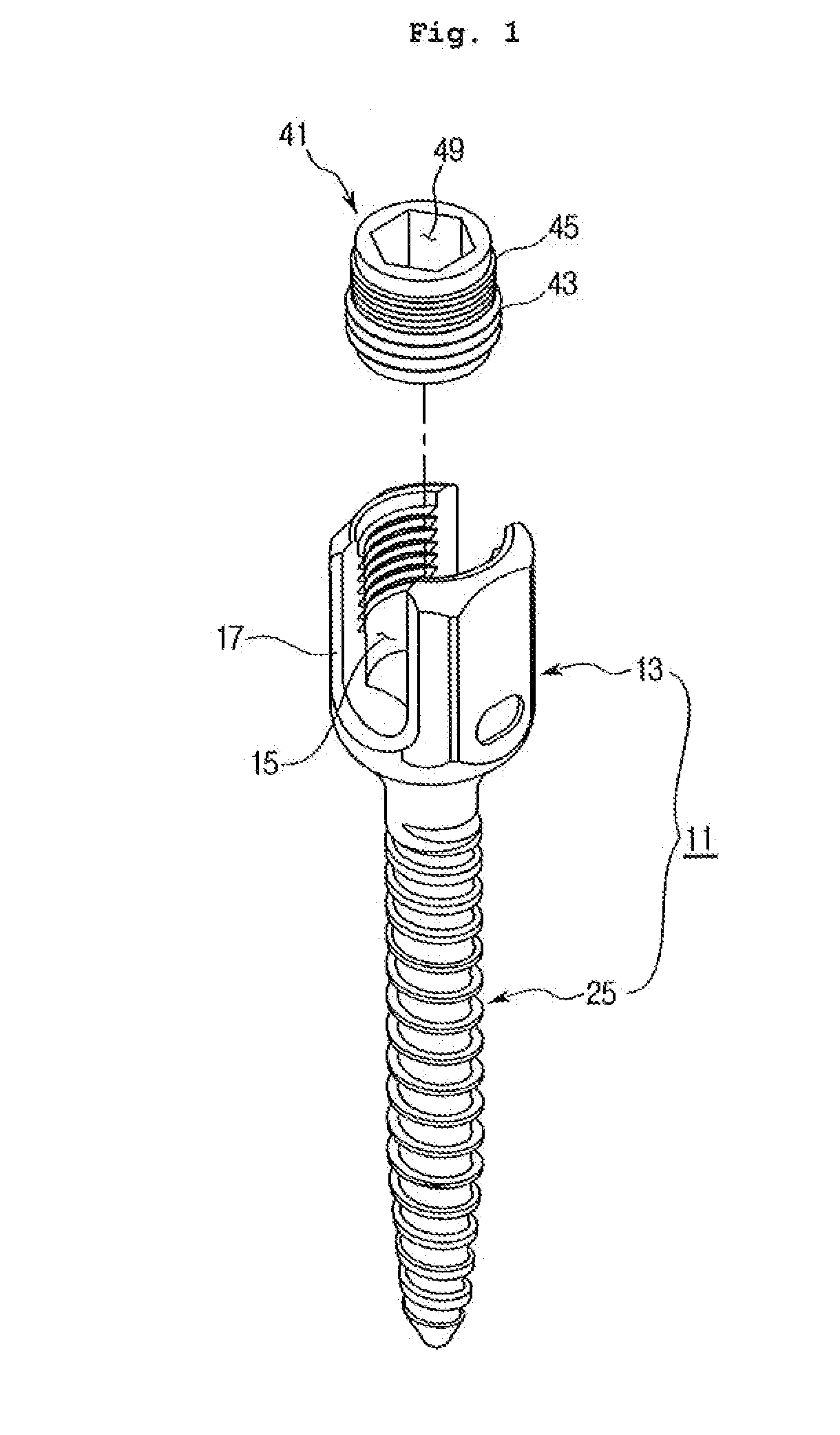 Spine Fixation Device Containing Set Screw Having Double Spiral Form