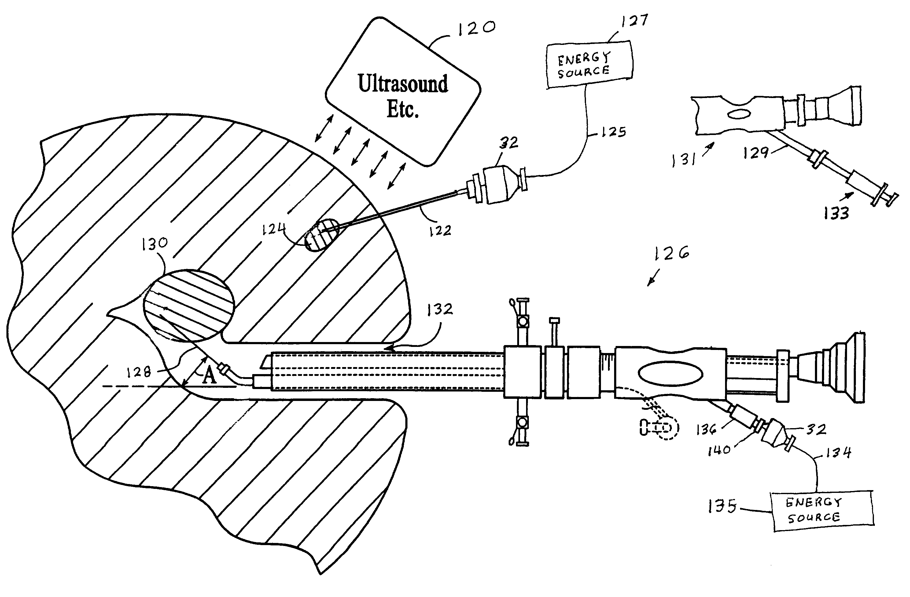 Method and apparatus for tissue treatment with laser and electromagnetic radiation