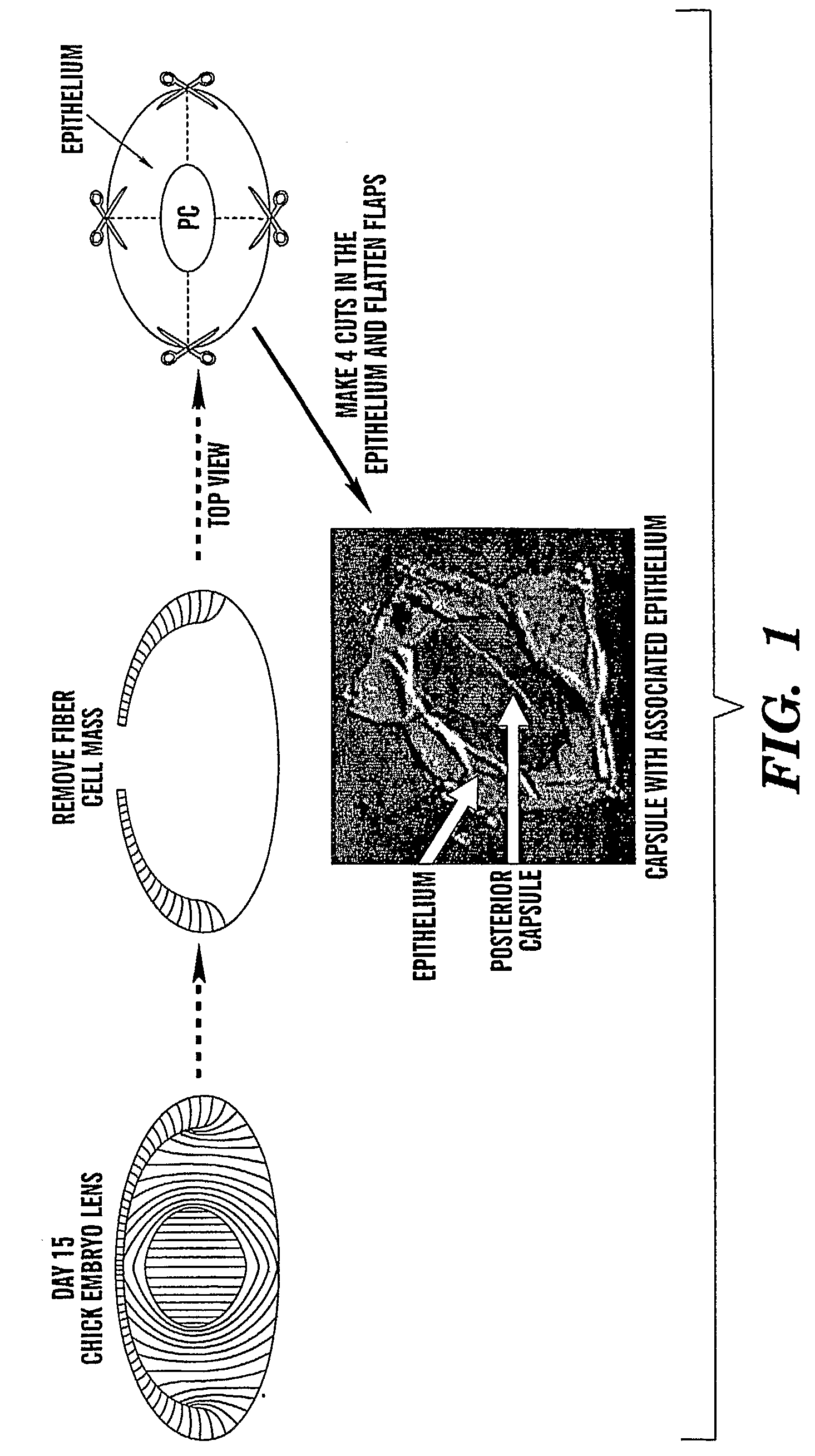 Method to Treat and Prevent Posterior Capsule Opacification