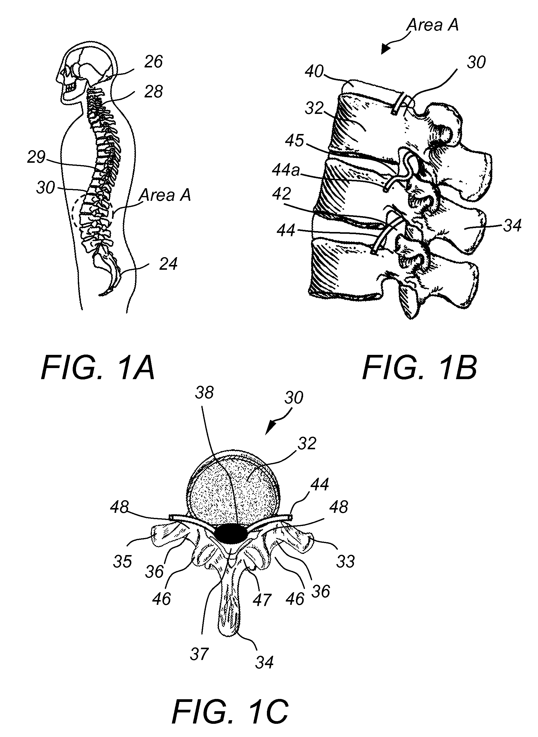 Spinous process fixation implant