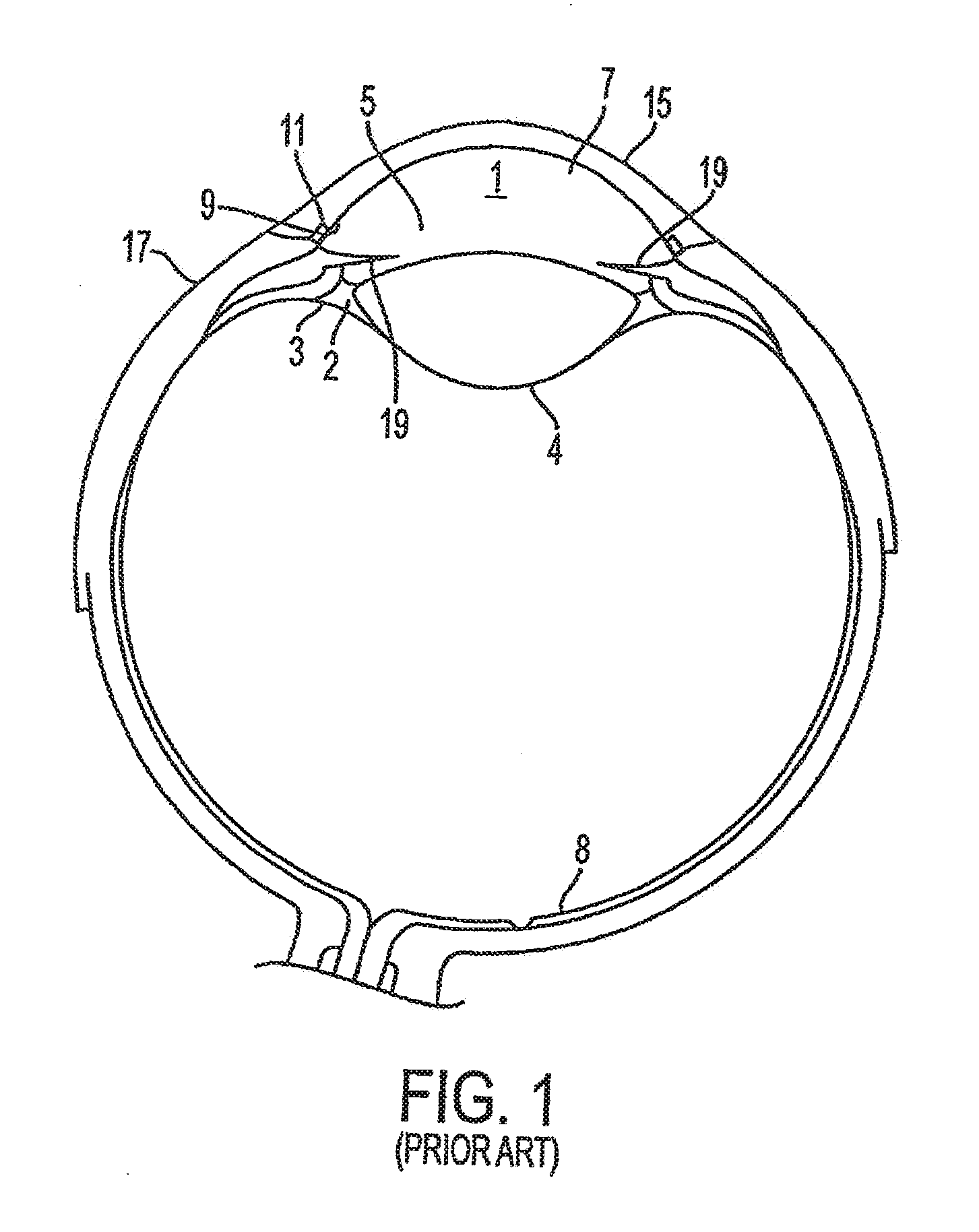 Delivery System and Method of Use for the Eye